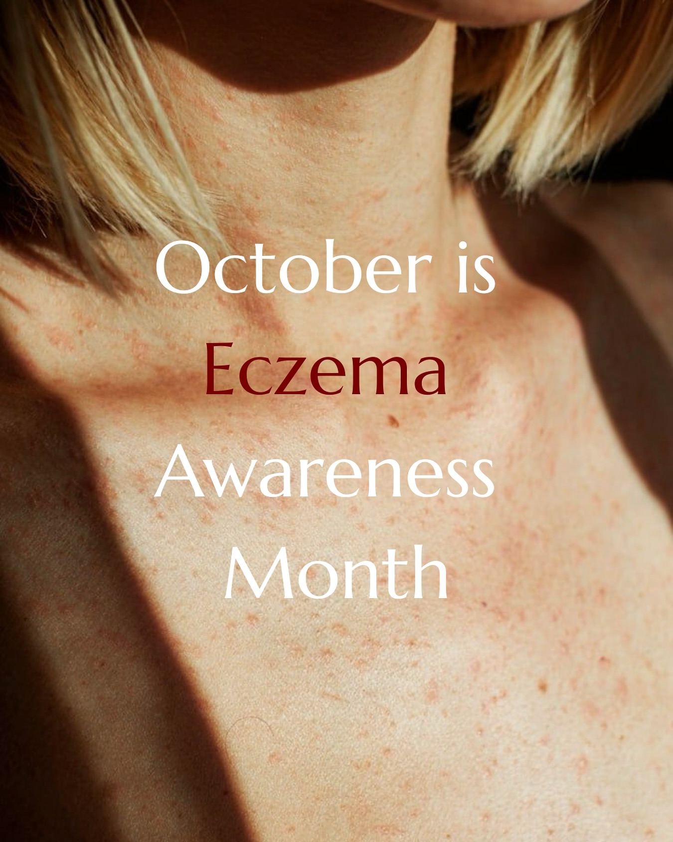 October is Eczema Awareness Month 💥
Did you know over 230 million people worldwide live with eczema?
That’s 1 in 10, with each journey unique.
Eczema isn’t “just a skin condition.”
It’s inflammation, a relentless itch, redness, broken sleep, and flare-ups that appear without warning.
For some, it’s mild irritation.
For others, it’s chronic pain, daily discomfort, and visible symptoms that go more than skin-deep.
The emotional toll is so often overlooked.
Confidence can erode, self-esteem suffers, and anxiety and depression can rise, especially when the world doesn’t see what it feels like.
We believe that no two people experience it the same and every experience deserves to be seen, heard, and respected. 🫶