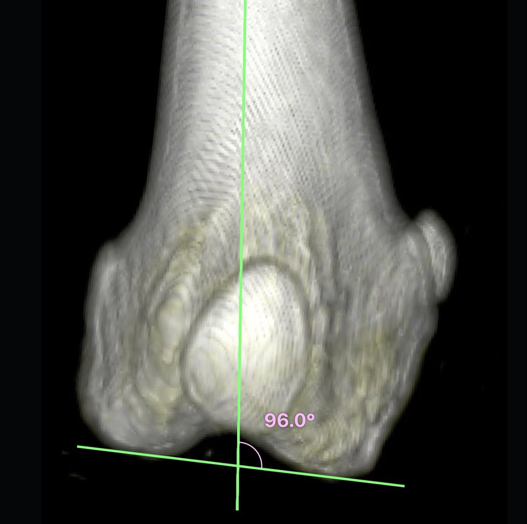 3D CT reconstruction of the left femur, and measurement of the anatomic lateral distal femoral angle (aLDFA), in a 6 year old female spayed Shih Txu Mix with a grade 2-3 medial patellar luxation.
———
According to Clark et al (VCOT 2023), a multicenter retrospective diagnostic-accuracy study comparing the anatomic lateral distal femoral angle (aLDFA) measured on caudocranial femoral radiographs with aLDFA from CT frontal-plane reconstructions (reference standard), radiographs on average overestimated aLDFA versus CT by 1.81°. Agreement was limited with a 95% limits-of-agreement span ~15.45°, and bias increased at higher angles. Radiography is a useful screening test: with the 102° cut-off, a negative result has very high NPV (98.08%) for excluding marked distal femoral varus relative to CT. However, absolute aLDFA from caudocranial radiographs should not be used alone for definitive planning of distal femoral osteotomy because of wide individual variation versus CT.