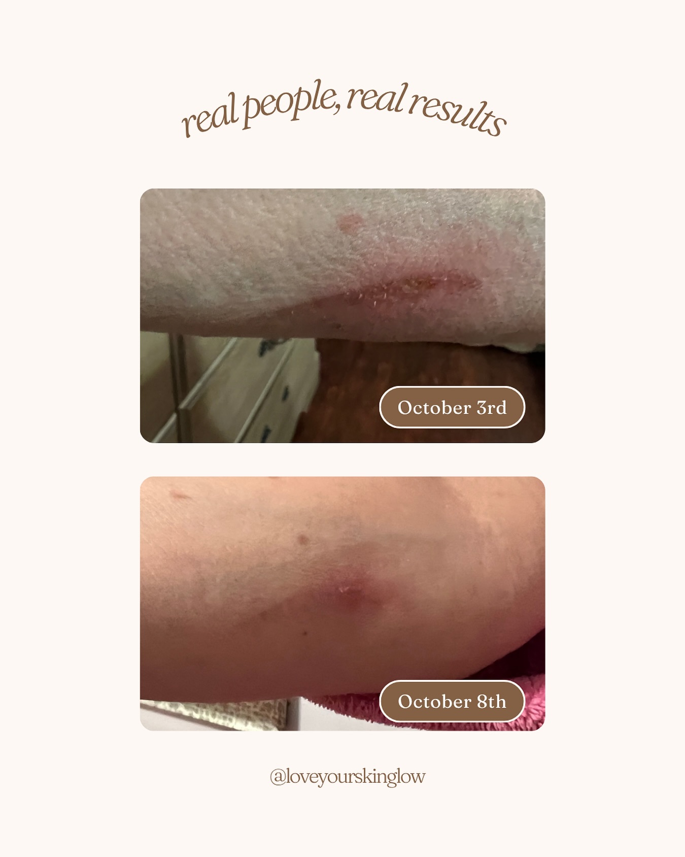 Look at the 5 day difference of the scar using our Vitamin E Ointments 😍✨
#LoveYourSkinProducts #Beauty #Skincare #VitaminE #SkinEssential #GlowingSkin