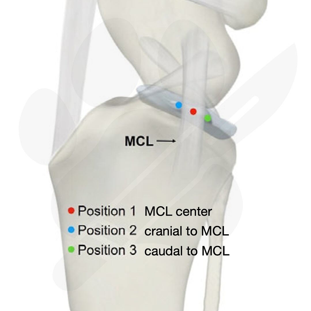 Surgeons commonly reference the medial collateral ligament (MCL) intraoperatively, but objective quantification of its relationship to tibial intercondylar eminence (TIcE; stifle center used for TPLO planning) was limited. This study demonstrates high inter-evaluator agreement and identifies CCL-status-dependent flexion targets (90° intact; 135° transected) for minimizing TIcE localization error. It contrasts with work that questioned MCL-based centering due to postoperative eccentricity, by focusing specifically on radiographic proximity of the landmark to TIcE under controlled conditions. Translation to clinical outcomes remains untested.
———
Ex vivo experimental lab study using 20 stifles from 10 dogs (20–30 kg). A hypodermic needle was placed at three mediolateral positions relative to the medial collateral ligament (MCL)—center (C), cranial (Cr), caudal (Cd)—and imaged at two stifle flexion angles (90°, 135°) under two conditions: intact cranial cruciate ligament (CCL-In) and mechanically transected CCL (CCL-MT). The perpendicular distance (d, mm) from the needle to the tibial intercondylar eminence (TIcE; stifle center used for TPLO planning) was measured by three orthopedic surgeons. Inter-evaluator reliability was excellent (ICC 0.92, 95% CI 0.83–0.95). Effects of position, flexion angle, and CCL status were analyzed with a linear mixed model (Bonferroni-adjusted comparisons, α=.0125). Limits: cadaveric model, medium-size dogs only, no clinical outcomes, and no assessment of proximal–distal needle variation.
The study provides a practical intraoperative landmark for centering the TPLO osteotomy. In intact CCL stifles, the MCL center at 90° had the smallest mean offset from TIcE (d=0.45±2.39 mm). In CCL-deficient stifles, the MCL center at 135° was closest (d=0.11±2.18 mm). Overall, 135° flexion tended to reduce |d| compared with 90°, and CCL deficiency altered the optimal flexion angle for using the MCL center as a TIcE proxy. These findings support level-aware use of the MCL center to localize TIcE during TPLO setup, while acknowledging individual variability (~2 mm SD) and the absence of outcome data.