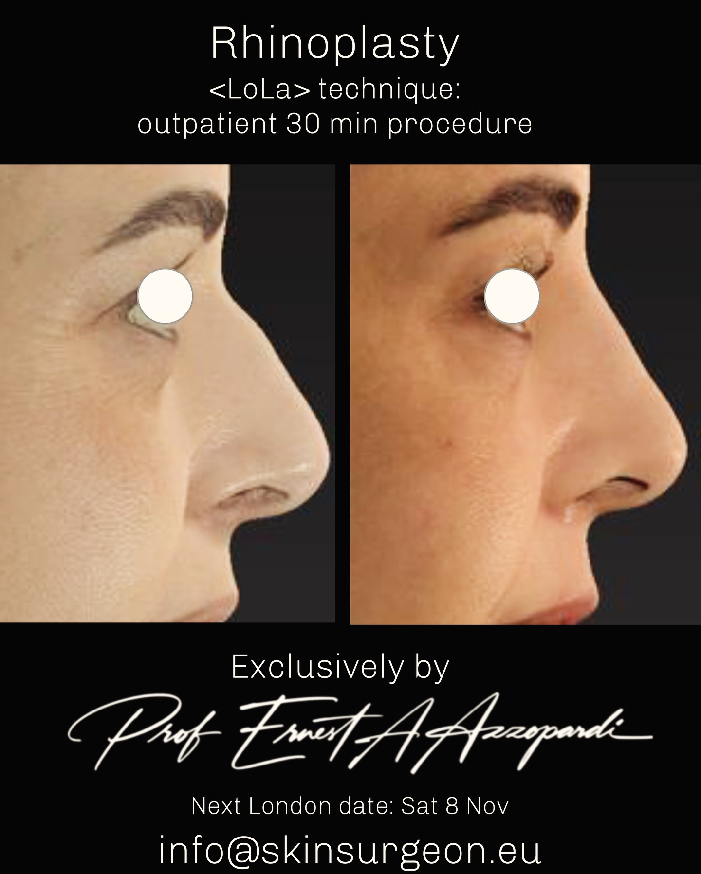 Layered Onlay Liquid Augmentation
Correction of dorsal hump and re symetrisation
Outpatient, simple, painless.
In the nose less is more
Learn about our new signature technique
Safe and effective
Exclusively at Skinsurgeon by Prof Ernest Azzopardi
London UK 🇬🇧 & 🇲🇹 Malta
Next London date sat 8 nov 2025
Final appointments remaining
📧 Info@skinsurgeon.eu
🛜 Www.skinsurgeon.eu
*all patients require consultation and examination prior to procedure. Performed by licensed and registered plastic surgeon, BAAPS & BAPRAS member. Thanks to our patient for allowing us to share and learn from the results