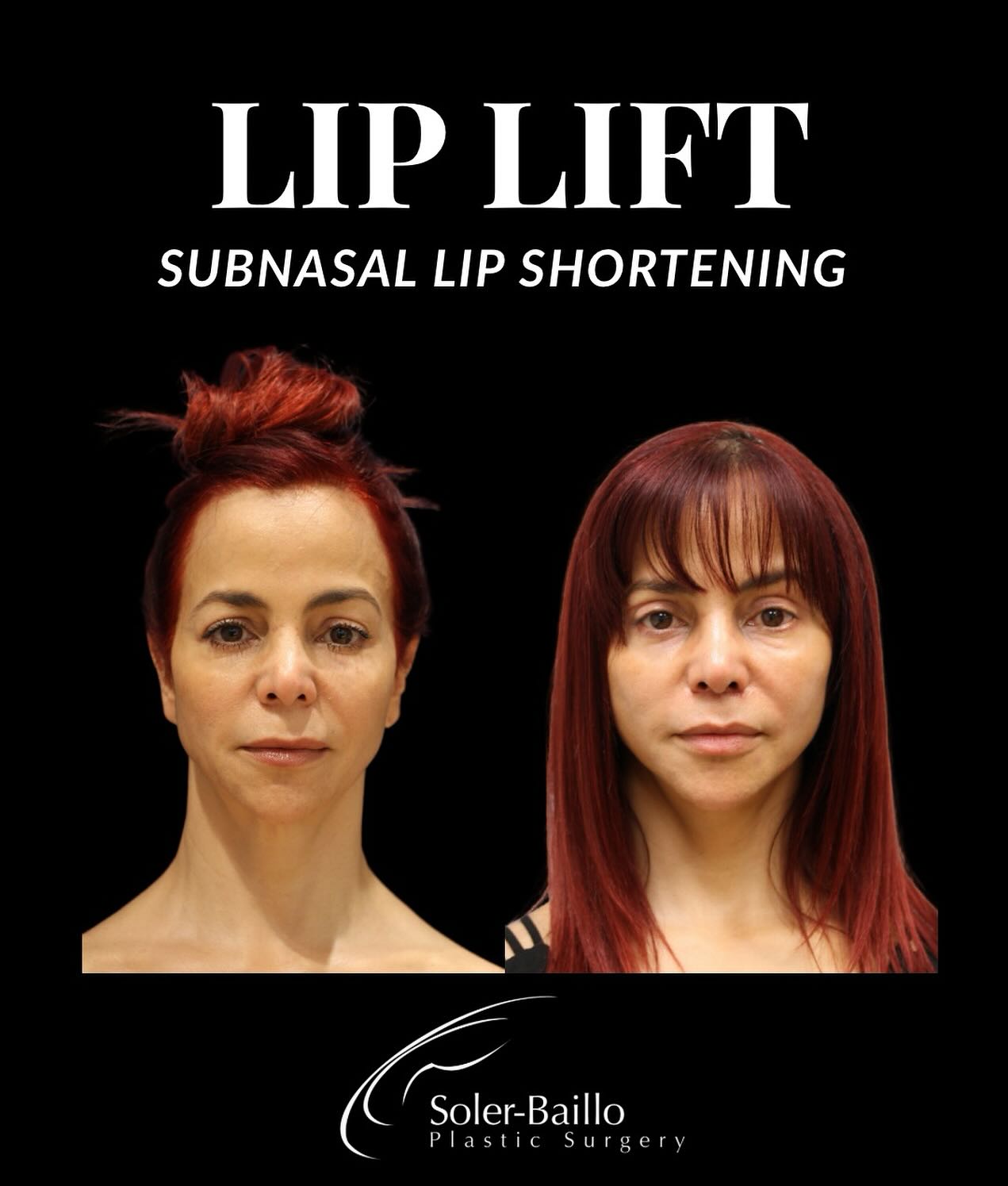 💋Permanent lip rejuvenation.
Enhance your natural beauty with a Lip Lift (Subnasal Lip Shortening) - a refined surgical technique that shortens the space between the nose and upper lip to restore youthful balance and definition. ✨
💄Unlike fillers, a Lip Lift creates lasting, natural enhancement by lifting and shaping your own lip tissue - no added volume, just beautifully proportioned results.
🩺 Performed by Dr. Soler-Baillo
📞(305) 661-1996
📍Shops at Merrick Park, Coral Gables
#liplift #liprejuvenation #liprefresh #lipshortening #drsolerbaillo