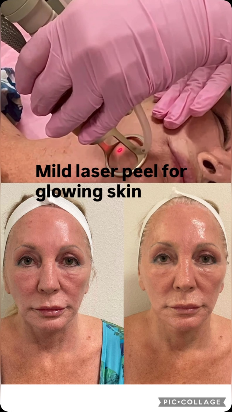 Better skin in 5 days #capricebeautybar #age #theskingames2024 #tampabay #sarasotaflorida #medspa #hifu #skin #sarasota #siestakeybeach