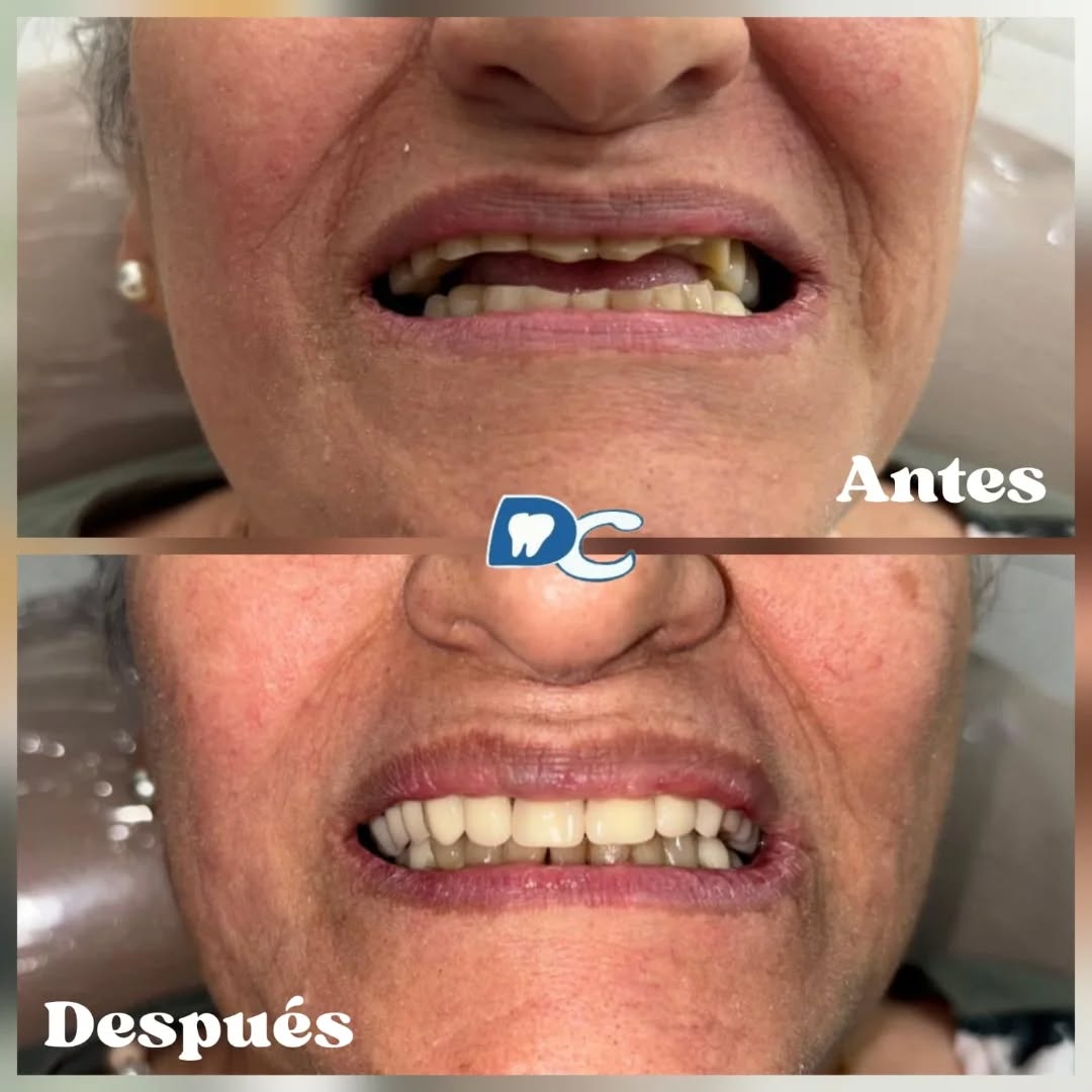 Una sonrisa puede cambiarlo todo 💫
Este antes y después lo demuestra.
Porque no hay nada más bonito que volver a sonreír sin miedo.
📅 Agenda tu valoración hoy mismo
📍 Denticali – Cali, Colombia
📲 Envíanos un mensaje y empieza tu cambio
3042167585/3178061353