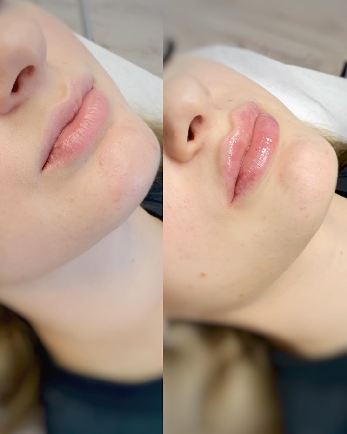 Huulien muotoilua täyteaineella 🫦