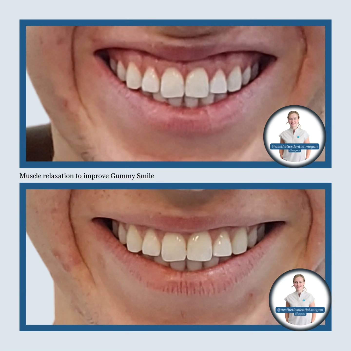 👋Did you even know this is something we can change if you don't like it?!
A gummy smile is often just an overactive muscle pull!
It can leave you feeling self conscious in photos or even bother your gums leaving them feeling dry and irritated.
Some patients even prefer to hide the gum/tooth line to disguise dark dental crowns or dental implant work.
By relaxing the muscles at play, we can keep your cheesy grin 😜 but create a better lip photo frame your teeth. 👌
Literally 2 injections. Works within the fortnight. Lasts on average 3 months.
Curious? 🤔 Send me a message or hit that link in bio to book your consultation!
Megan x
Dentist led aesthetics & skincare in Glasgow
#gummysmile #drygums #perfectsmile
