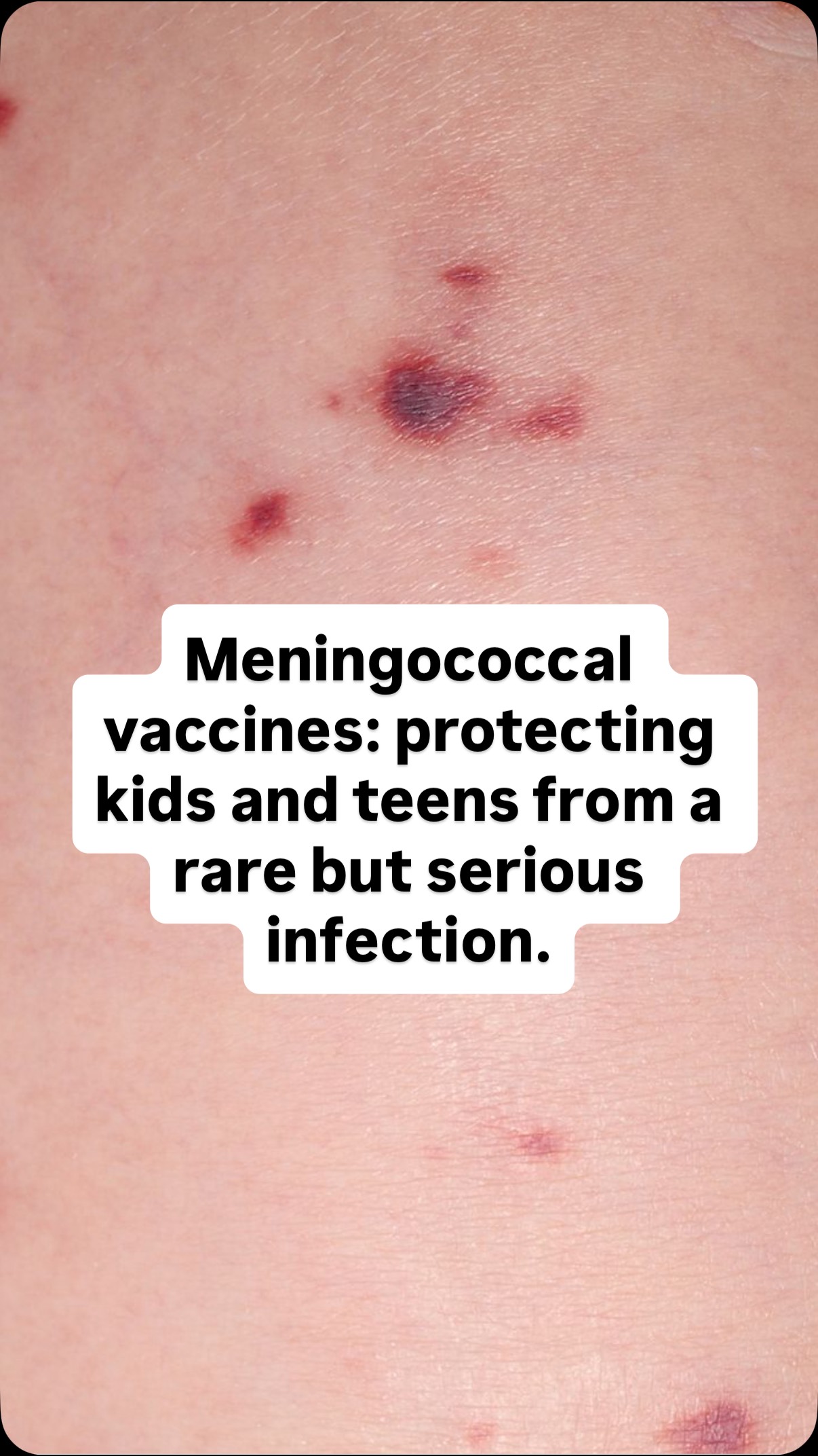 What’s the difference between Menactra and Bexsero?
A quick guide to meningococcal vaccines for parents