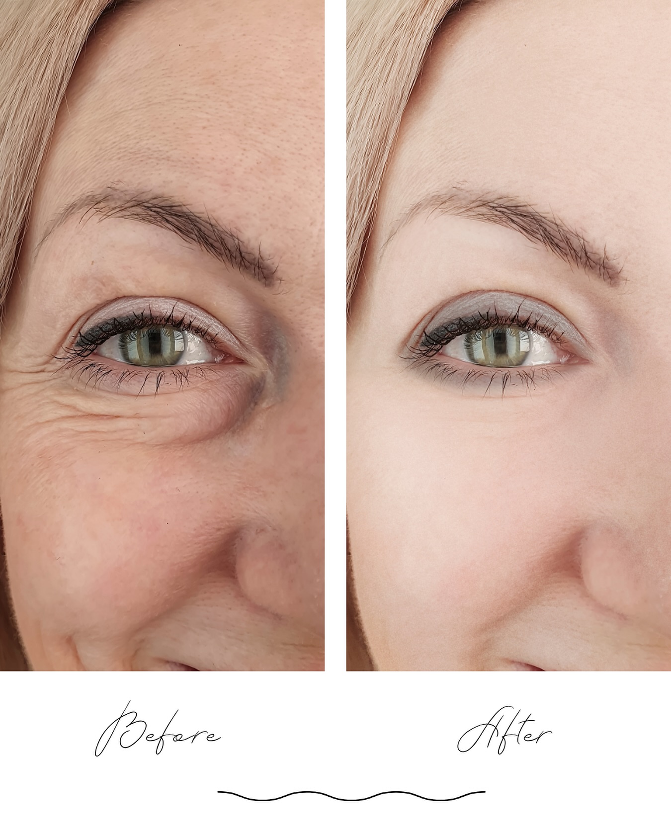 💫 Verjüngung ohne OP 💫
Natürlich‼️ Effektiv‼️Langanhaltend‼️
Seit über 16 Jahren sind wir spezialisiert auf Behandlungen, die dich sichtbar verjüngen – ganz ohne chirurgischen Eingriff und ohne Unterspritzung 💉🚫
Egal ob Gesicht oder Körper, bei uns findest du die passende Methode, um deine Haut zu straffen, zu regenerieren und zum Strahlen zu bringen 💖
All unsere Methoden wirken ausschließlich auf natürliche Weise, um deine eigene Kollagenproduktion zu aktivieren und deine Haut von innen heraus zu verjüngen 🌿🌸
💎 Facelifting ohne OP & ohne Spritzen
💎 Natürliche Hautstraffung & Glow
💎 Langanhaltende, sichtbare Ergebnisse
Wir erstellen für dich ein individuelles Behandlungskonzept, das perfekt zu deinen Bedürfnissen passt – für ein frisches, jugendliches und natürlich schönes Aussehen ❤️
✨ Vereinbare jetzt dein persönliches Beratungsgespräch und entdecke, wie schön Verjüngung auf ganz natürliche Art sein kann! ✨
#verjüngung #facelifting #hautstraffung #beautylounge #hamburgbeauty #jugendlichehaut