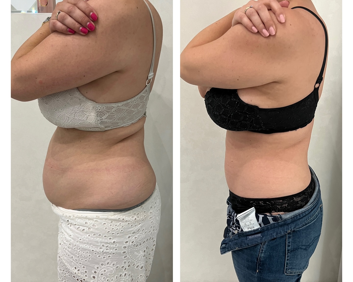 Wie funktioniert die VelaShape3 Behandlung❓🤔❓
Die VelaShape3 -Technologie wirkt in drei gezielten Behandlungsphasen mithilfe von:
1. Infrarotlicht (IR)
• Erwärmt das oberflächliche Gewebe (bis ca. 3 mm)
• Regt die Kollagenneubildung an
• Verbessert die Hautelastizität
2. Bi-polare Radiofrequenz (RF)
• Dringt tiefer in die Haut ein (bis zu 15 mm)
• Reduziert gezielt Fettzellen
• Strafft das Gewebe und stimuliert die Durchblutung
3. Vakuumtechnik + mechanische Rollmassage
• Hebt das Gewebe sanft an
• Fördert den Lymphfluss und die Entgiftung
• Lockert Bindegewebsverklebungen bei Cellulite
Was spürt man während der Behandlung❓
Die Behandlung fühlt sich wie eine angenehme, warme Gewebemassage an. Es kann zu einer leichten Hautrötung oder Erwärmung kommen, was normal und gewünscht ist. Die Behandlung ist schmerzfrei und erfordert keine Ausfallzeit
Klinisch belegte Ergebnisse‼️
Klinische Studien haben bewiesen, dass die VelaShape III-Behandlung sichtbare und lang anhaltende Ergebnisse liefert. Bereits nach wenigen Sitzungen kommt es zu einer messbaren Umfangreduktion, glatterer Hautoberfläche und deutlich strafferer Kontur.
Die Wirkung kann je nach Lebensstil und Hautbeschaffenheit mehrere Monate anhalten.
Ergebnis nach 6 Behandlungen. 😍😍😍
VelaShap3, Hamburg, Cellulitebehandlung
#velashape #hautstraffung #cellulite