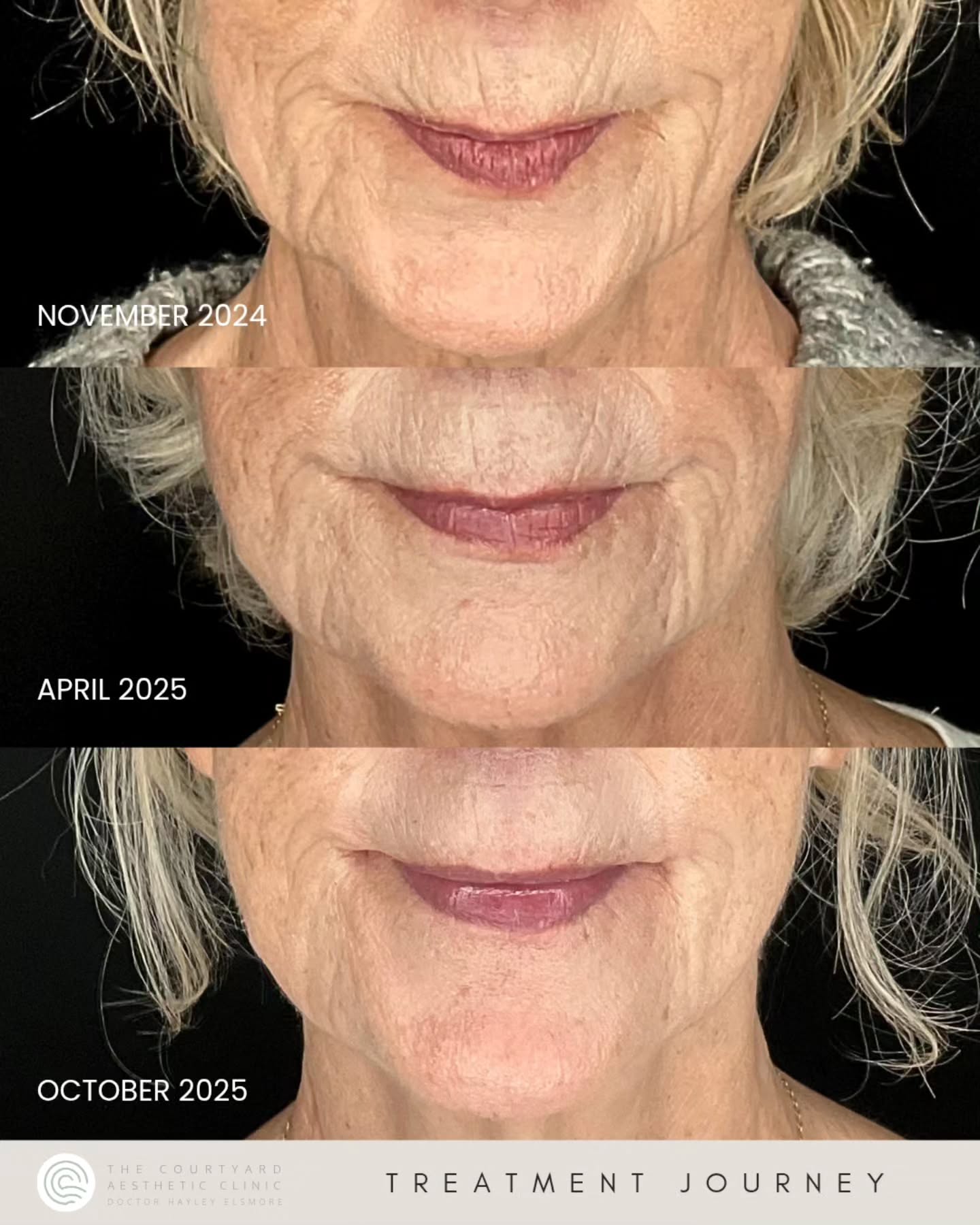 Ageing is inevitable, but looking your age doesn’t have to be ✨
This beautiful transformation shows the power of combining dermal fillers and polynucleotides to restore volume, improve skin quality, and gently turn back the clock.
This is a perfect example of how sometimes treatments are a journey, not an instant fix.
These results, taken over nearly 12 months, highlight how consistency and expert care can deliver natural, age-defying results - never changing who you are, only enhancing 💫
#aesthetictreatment #polynucleotides #filler #dermalfiller #turnbacktheclock #naturalresults #ageing #skindoctor #aestheticclinic #injectabletreatments #rejuvenate #ageingskin #iow #isleofwight