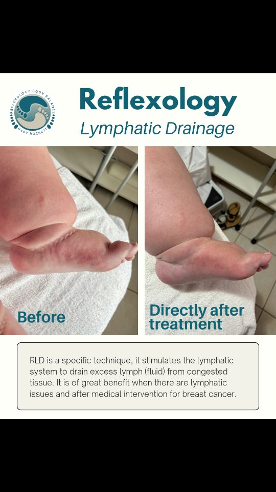 ✨ Swollen feet? You need lymphatic drainage!
As the weather warms up, do your legs, feet or ankles start to feel heavy, swollen, or puffy? 💦
🌸 Here’s why RLD can help:
• Stimulates lymph flow to reduce edema and lymphedema
• Gently encourages the body to release trapped fluid and toxins
• Helps ease that “tight, heavy leg” feeling
• Boosts your immune and detox systems naturally
• Leaves you feeling lighter and more mobile
This summer support your lymphatic system 👣
📍 Randburg 📲 Book online
🔗 reflexologybodybalance.co.za
#swollenfeet #lymphaticdrainage #edema #reflexology #lymphedema #ReflexologyBodyBalance #reflexologynearme