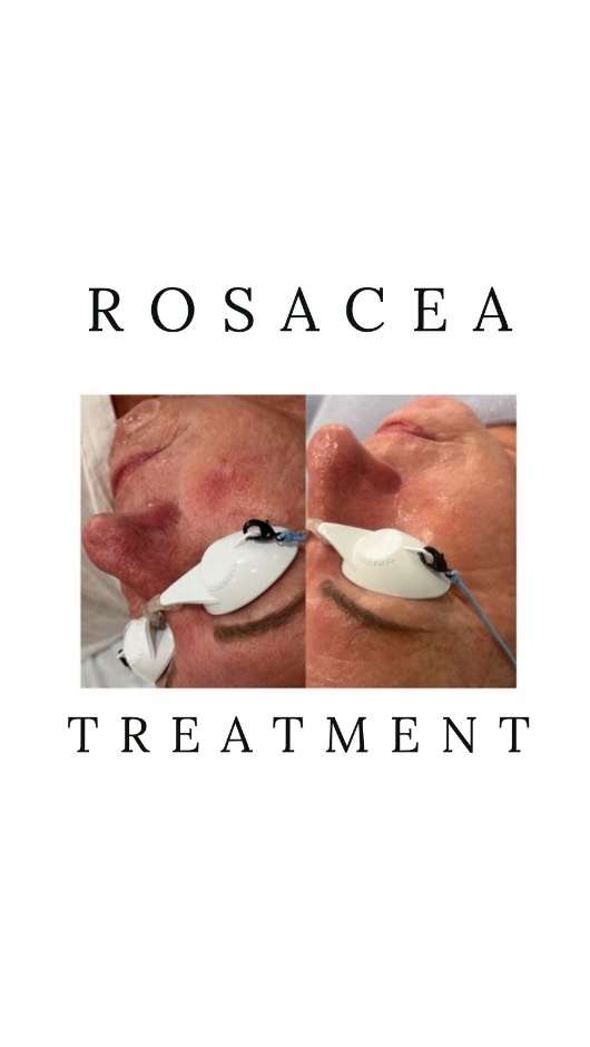 R O S A C E A 🔥
is a chronic skin condition characterized by redness, flushing, and visible blood vessels on the face.
Treatment options include:
Topical and Oral medications as well as Laser Therapy ⚡️
Laser treatments can target and destroy dilated blood vessels, reducing redness and flushing.
Intense pulsed light (IPL): IPL therapy uses pulses of light to target and destroy blood vessels and reduce inflammation. As seen above 👆🏼 💫
#ipl#rosaceatreatment#syracsueskincare#baldwinsvilledayspa