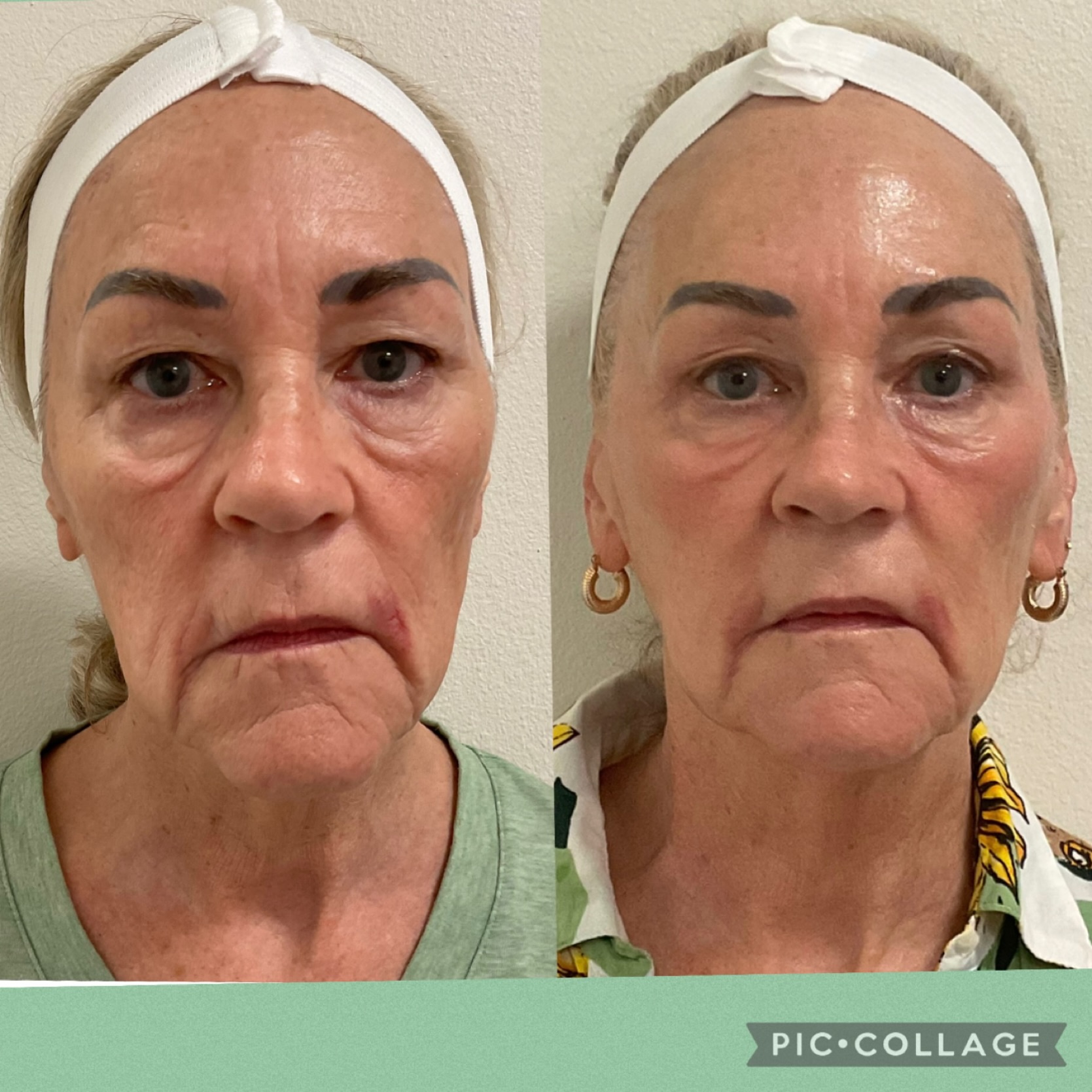 3 weeks for better lifted skin …more to come ..
#capricebeautybar #sarasota #tampa #orlando #skin #age #liftingskin #hifu #co2laser #siestakey