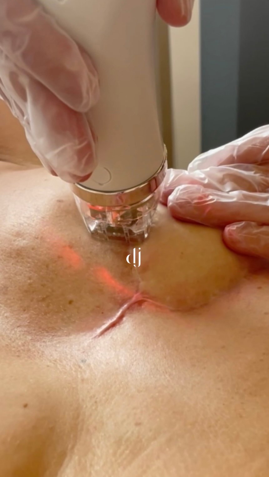 Scar Revision - 𝐌𝐞𝐝𝐢𝐜𝐚𝐥 𝐍𝐞𝐞𝐝𝐥𝐢𝐧𝐠 & 𝐒𝐜𝐚𝐫 𝐂𝐚𝐦𝐨𝐮𝐟𝐥𝐚𝐠𝐞 𝐭𝐚𝐭𝐭𝐨𝐨 𝐏𝐌𝐔
Treating scarring takes time but the results are so rewarding and life changing. The difference to make to the appearance, consistency and condition of any scars is a major transformation. While i always tell clients results via my goal is always a strong percentage improvement to the area.
With commitment to the treatment plan from the client we work together. Once i am happy with the condition of the treated skin and scarring we can then also use medical tattoo (scar camouflage) to bring life and matching skin back so we have a more blended even finish.
𝒯𝒽𝒾𝓈 𝒶𝓂𝒶𝓏𝒾𝓃𝑔 𝒸𝓁𝒾ℯ𝓃𝓉 𝒽𝒶𝒹 𝒶 𝓂𝒶𝓈𝓉ℯ𝒸𝓉ℴ𝓂𝓎 𝒻ℴ𝓁𝓁ℴ𝓌𝒾𝓃𝑔 𝓉𝓇ℯ𝒶𝓉𝓂ℯ𝓃𝓉 𝒻ℴ𝓇 𝒷𝓇ℯ𝒶𝓈𝓉 𝒸𝒶𝓃𝒸ℯ𝓇. 𝒮𝒸𝒶𝓇 ℛℯ𝓋𝒾𝓈𝒾ℴ𝓃 𝓉𝓇ℯ𝒶𝓉𝓂ℯ𝓃𝓉𝓈,𝓂ℯ𝒹𝒾𝒸𝒶𝓁 𝓉𝒶𝓉𝓉ℴℴ 𝒶𝓃𝒹 𝒶𝓇ℯℴ𝓁𝒶 𝓉𝒶𝓉𝓉ℴℴ 𝓌𝒶𝓈 𝓉𝒽ℯ 𝓅𝓇ℴ𝓉𝒸ℴ𝓁. ℐ 𝒶𝓂 𝓉𝓇𝓊ℯ𝓁𝓎 𝑔𝓇𝒶𝓉ℯ𝒻𝓊𝓁 𝒻ℴ𝓇 𝓉𝒽ℯ 𝓌ℴ𝓂ℯ𝓃 𝒾 𝑔ℯ𝓉 𝓉ℴ 𝓂ℯℯ𝓉 𝒶𝓃𝒹 ℴ𝒻𝒻ℯ𝓇 𝓂𝓎 𝓈ℯ𝓇𝓋𝒾𝒸ℯ𝓈 𝓉ℴ.
ℒℴ𝓋ℯ 𝒟𝒶𝓃𝒾ℯ𝓁𝓁ℯ 𝓍
Booking in bio 🔝 (consultation required)
www.daniellejamesclinic.com
#permanentmakeup #semipermanentmakeup #areolatattoo #areolatattooliverpool #scarcamouflage #scarremoval #scartreatment #pmu #pmuartist #pmuartistliverpool #skintreatment #daniellejamesclinic