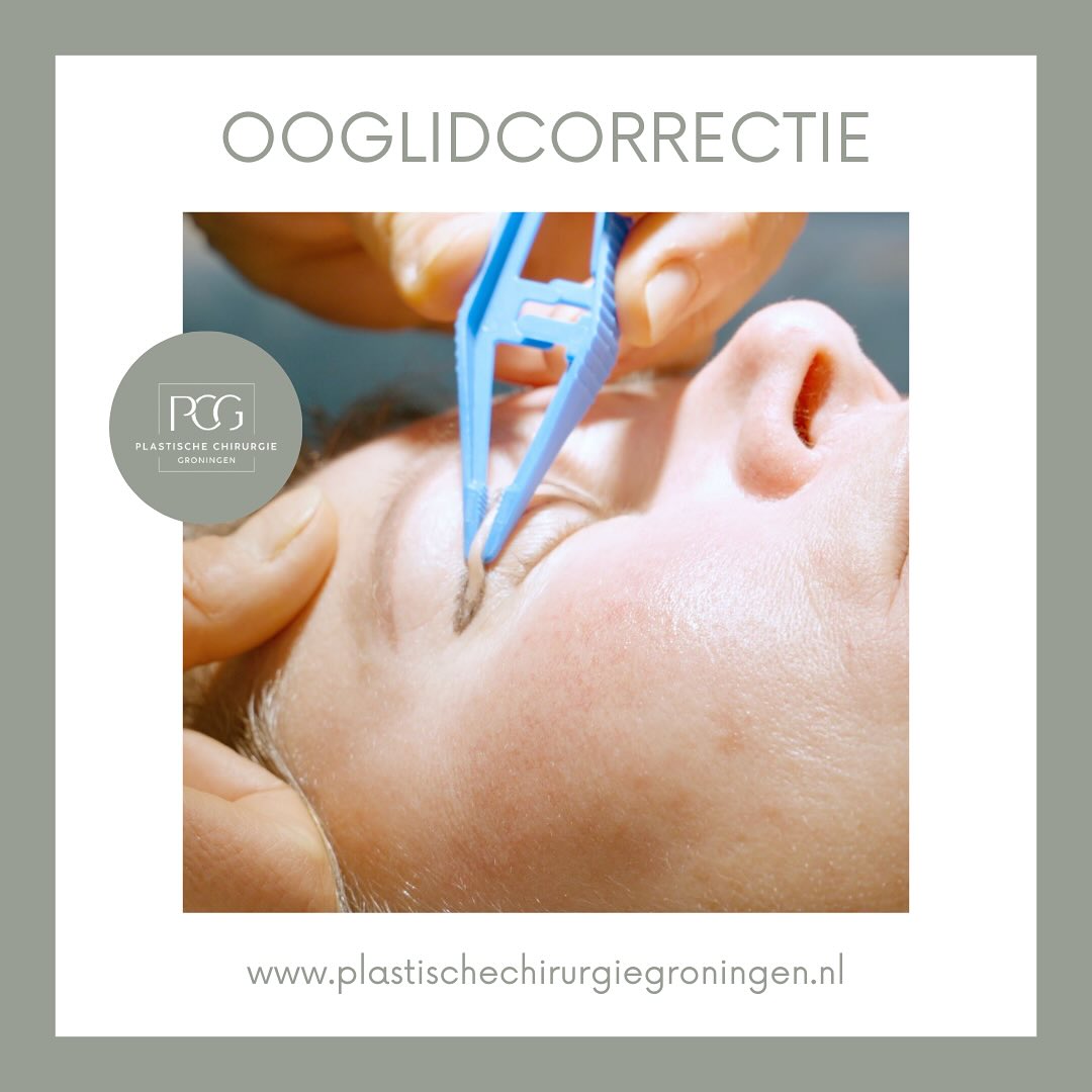 👀 Last van hangende oogleden of een vermoeide uitstraling? Dat hoeft niet zo te blijven! Een bovenooglidcorrectie kan het verschil maken, waardoor uw blik weer fris en open oogt, passend bij hoe u zich écht voelt.
Onze ervaren plastisch chirurgen staan klaar om u te helpen met een natuurlijke en mooie resultaat. ✨
Meer weten over de mogelijkheden?
📞 050 - 211 04 96
💌 info@pcgroningen.nl