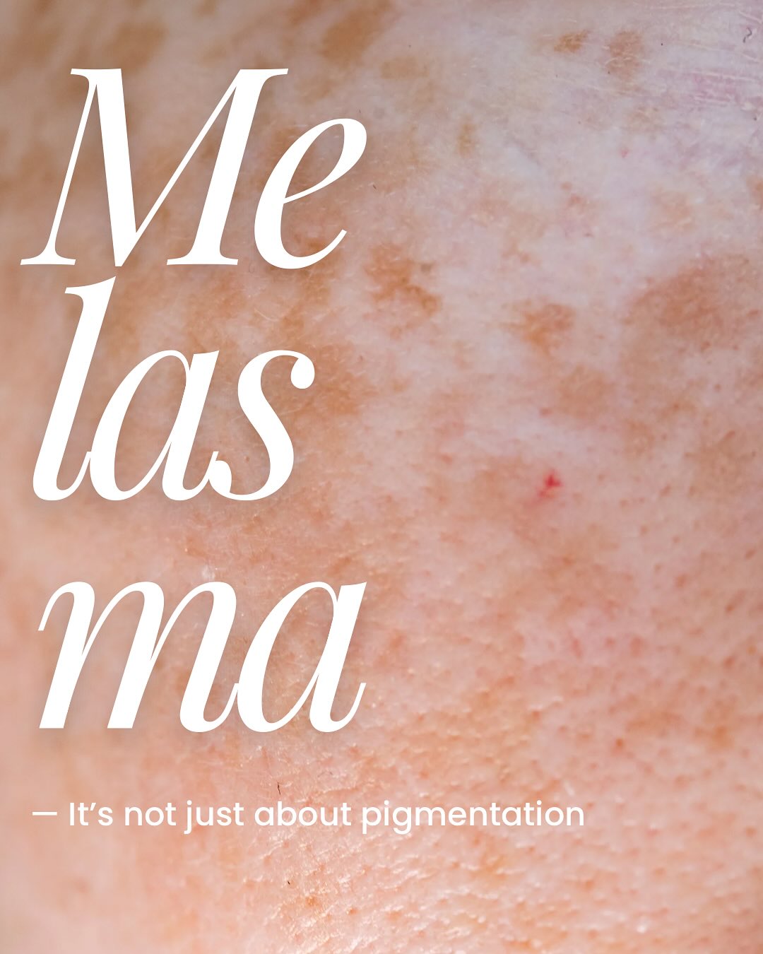 There are many types of hyperpigmentation, in this post, I am referring specifically to melasma.
Would you also like to know more about other forms of hyperpigmentation? Let me know 👇🏼
#hyperpigmentation #melasma #hormones #hormonehealth #skin #skincare #somersetwest #postpregnancy #postpregnancyskin