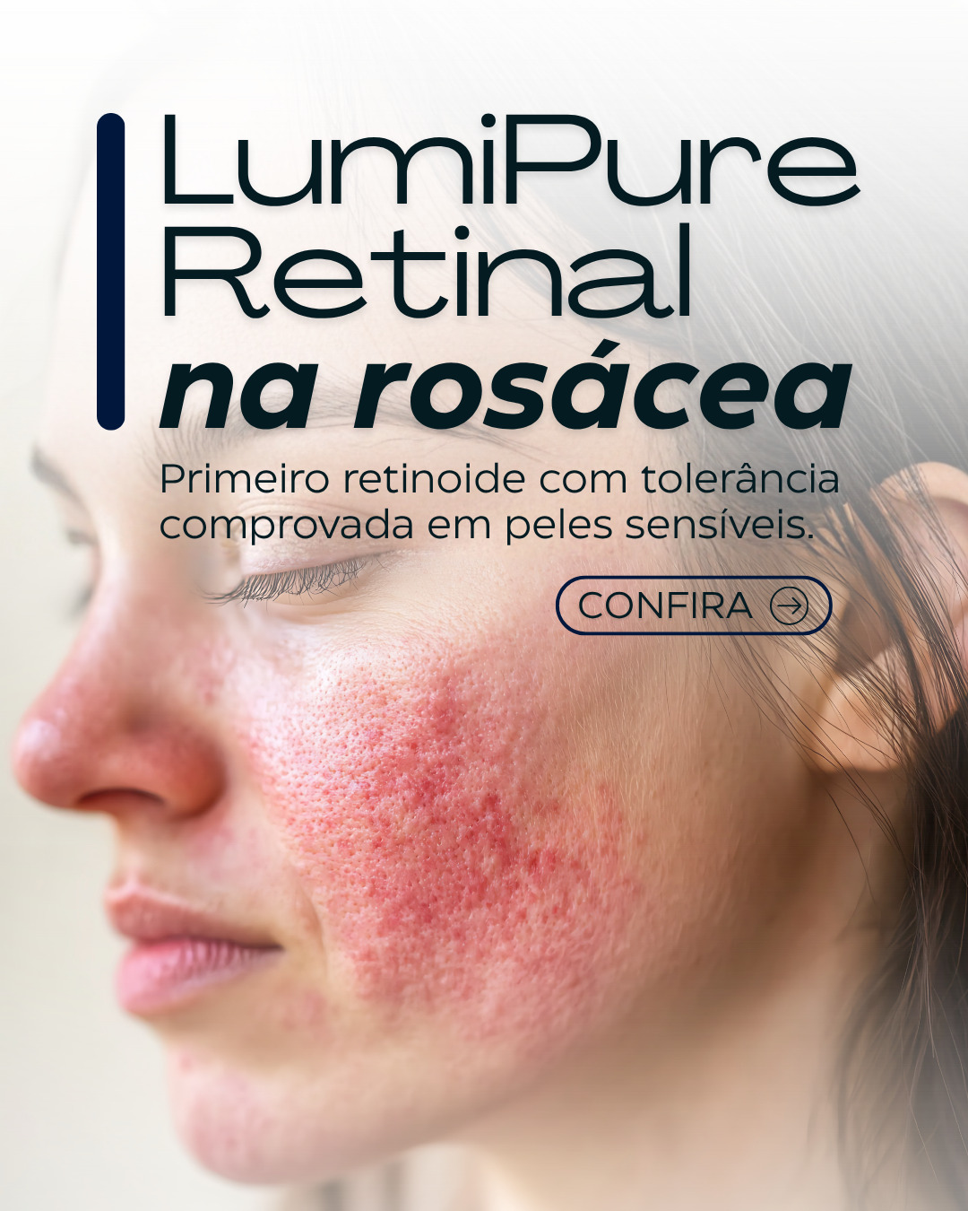 ✨Tolerância clínica. Potência comprovada. Resultados visíveis.
O LumiPure® Retinal é o novo padrão em retinoides cosméticos: 11x mais potente que o retinol, com tolerância comprovada em peles sensíveis e com rosácea.
🔬 Evidência clínica:
📈 75% das pacientes apresentaram melhora visível do eritema após 5 meses.
🔻 Redução de 15% no parâmetro de vermelhidão (a*) em apenas 2 meses.
💧 Melhora gradual das telangiectasias e textura cutânea.
Graças à sua conversão enzimática controlada, o LumiPure® Retinal estimula a síntese de colágeno, melhora a barreira cutânea e atua na modulação inflamatória, com ação antimicrobiana e clareadora da pele.
⚡ Um ativo inteligente que transforma sem agredir.
PureKemika — ciência aplicada com pureza e performance.
📩 Quer o dossiê técnico e formulações exclusivas com LumiPure® Retinal? Fale com nosso time científico.
#LumiPureRetinal #PureKemika #RetinoideDeNovaGeração #Rosácea #PeleSensível #CiênciaAplicada #CosméticaAvançada #AtivosDeAltaPerformance #FormulaçãoInteligente #ProAging #InovaçãoCosmética #PeleSaudável #Dermocosmético