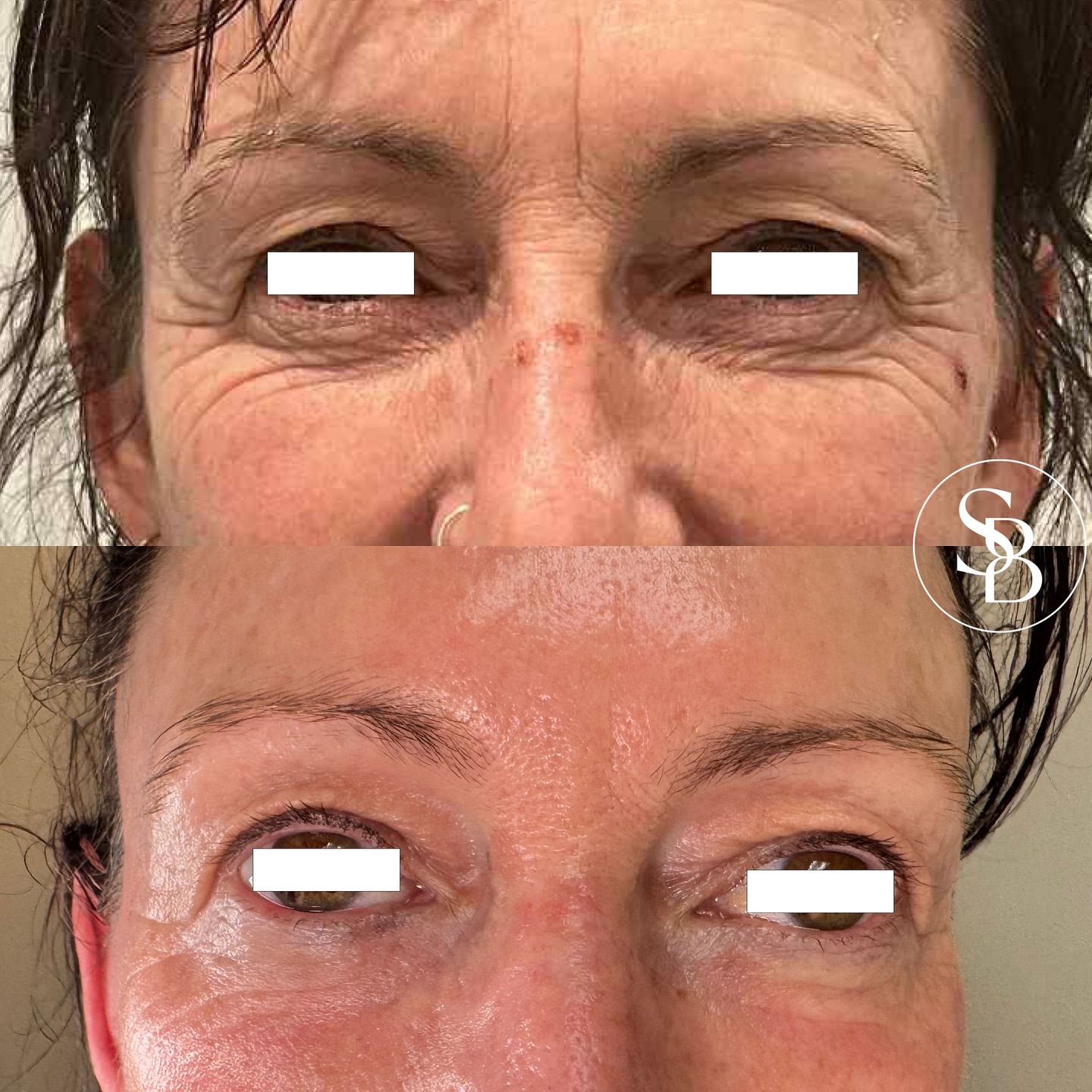 ONE TREATMENT TO ACHIEVE THESE RESULTS ‼️
This stunning transformation was achieved with our Plasma Pen, designed to tighten, smooth and rejuvenate delicate eye-area skin without surgery.
Noticeably fewer lines, firmer texture and brighter skin!
Book your consultation today to find out if this treatment is right for you 🙌🏼
#plaxpotplasma #plasmafibroblast #nosurgicalfacelift #skinshrinking #eyelift