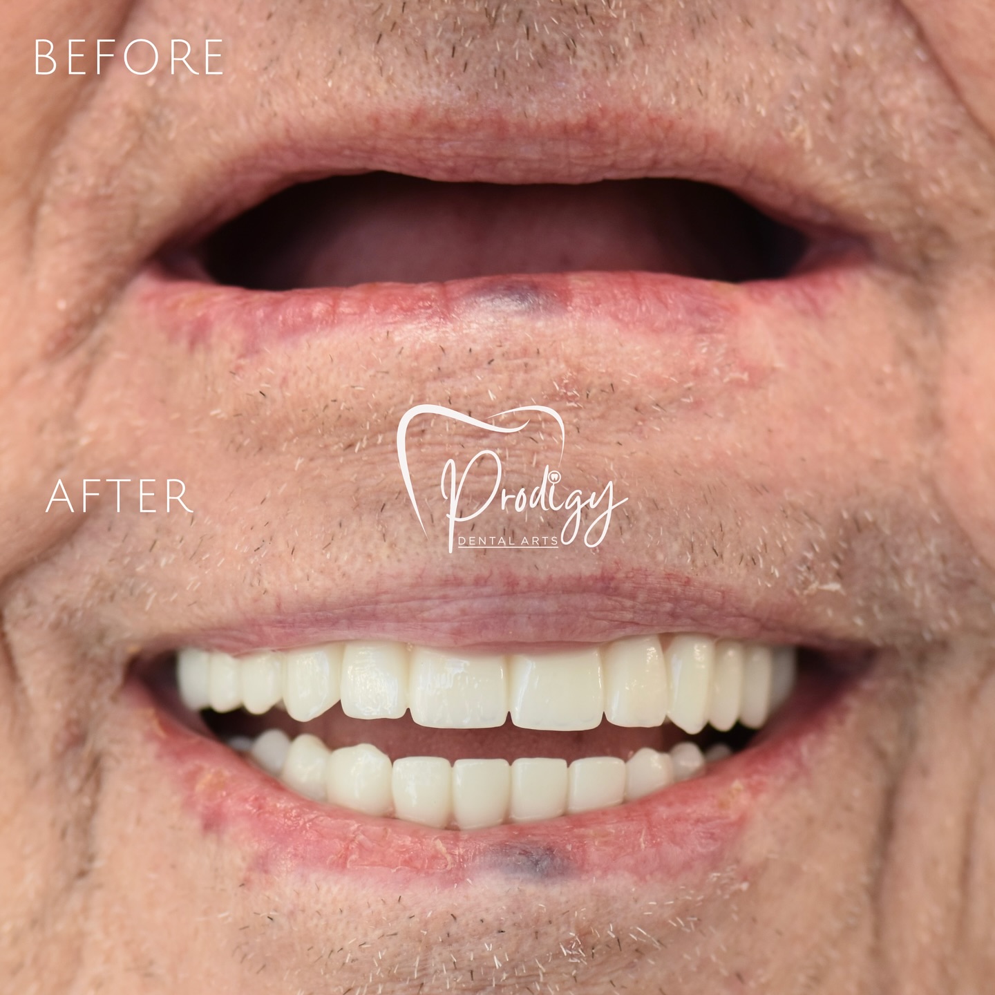 Before → After
No more loose dentures!
With a fixed bridge supported by 5 implants on the top and 5 on the bottom, you can enjoy a stable, natural-feeling smile again.
Eat, laugh, and live with confidence — every single day.
Send us a message to find out how this solution can change your life.
#implants #allon4 #ImplantBridge #FullMouthRestoration #ConfidentSmile #SmileTransformation #TeethImplants #NewSmileJourney#NoMoreDentures #SmileWithConfidence