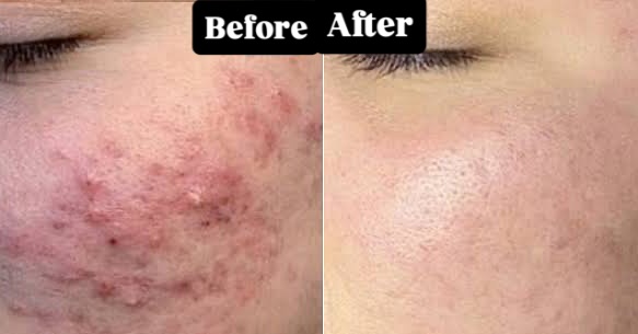 BioRePeel Transformation — 6 Sessions Later
What a journey it’s been!
After 6 consistent BioRePeel sessions, the skin is visibly clearer, smoother, and more radiant than ever — breakouts reduced, scars faded, and that healthy glow fully restored.
BioRePeel works on a deeper level — exfoliating, renewing, and repairing the skin from within without any downtime. It’s perfect for treating acne, pigmentation, uneven texture, and dullness.
Consistency truly pays off when it comes to skin health. Invest in your skin and let your natural glow shine through
#BioRePeel #RealResults #GlowingSkin #ClearSkinJourney #HauteEsthetics #SkinTransformation #LuxurySkincare #RadiantSkin #ConsistencyIsKey #HealthySkinGoals