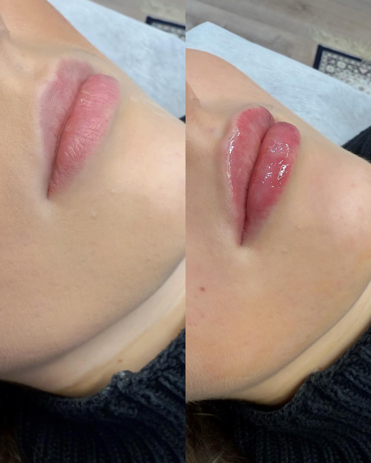 Huulien muotoilu täyteaineaineella. Hoidossa käytetty 1ml täyteainetta, joka aseteltu tasaisesti kudokseen tuomaan täyteläisyyttä ja korostamaan reunoja. 🥰💋