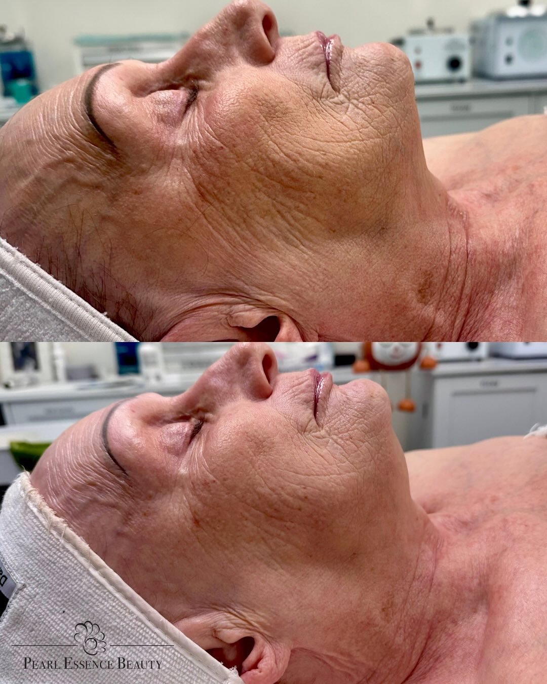 ✨ Real Results with Procell Microchanneling ✨
Our client underwent 4 Procell Pro sessions spaced 3 weeks apart, and the transformation speaks for itself. 💫
This non-invasive treatment stimulates collagen and elastin production to help:
💧 Smooth fine lines and wrinkles
🌸 Refine texture and acne scarring
☀️ Brighten and even skin tone
💪 Firm and tighten lax skin
Each session builds on the last — delivering visible, long-lasting improvements in skin health and radiance.
We offer Procell in session packages for optimal results, allowing your skin to progressively renew and strengthen from within.
Experience the next generation of skin rejuvenation — your glow starts here. 🤍
#PearlEssenceBeauty #ProcellMicrochanneling #SkinTransformation #GlowingSkin #CollagenBoost #RohnertParkEsthetician #MicroneedlingAlternative #ProcellResults #SkinRejuvenation #CaliforniaEsthetician