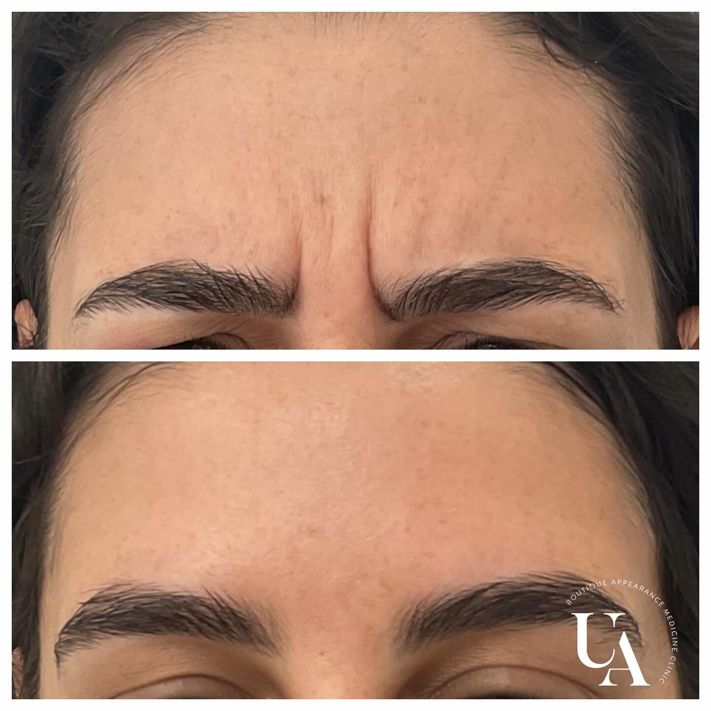 Love results like this! Frown antiwrinkle has to be one of the most asked for areas! 😍
#kapiticoastnz #injectorlife #lovemyjob