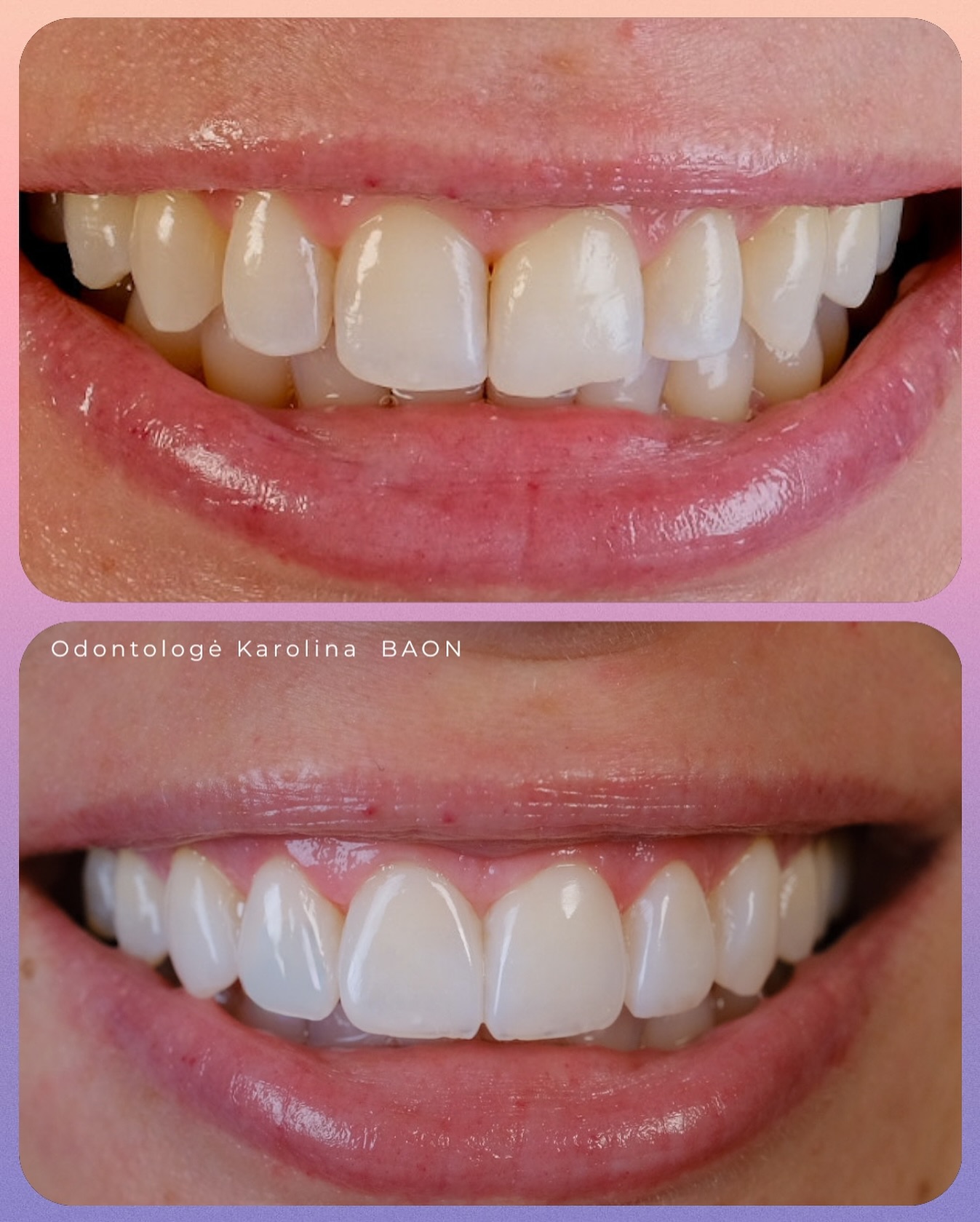 Kompozitu padengimas. Anatomijos ir proporcijų atstatymas.