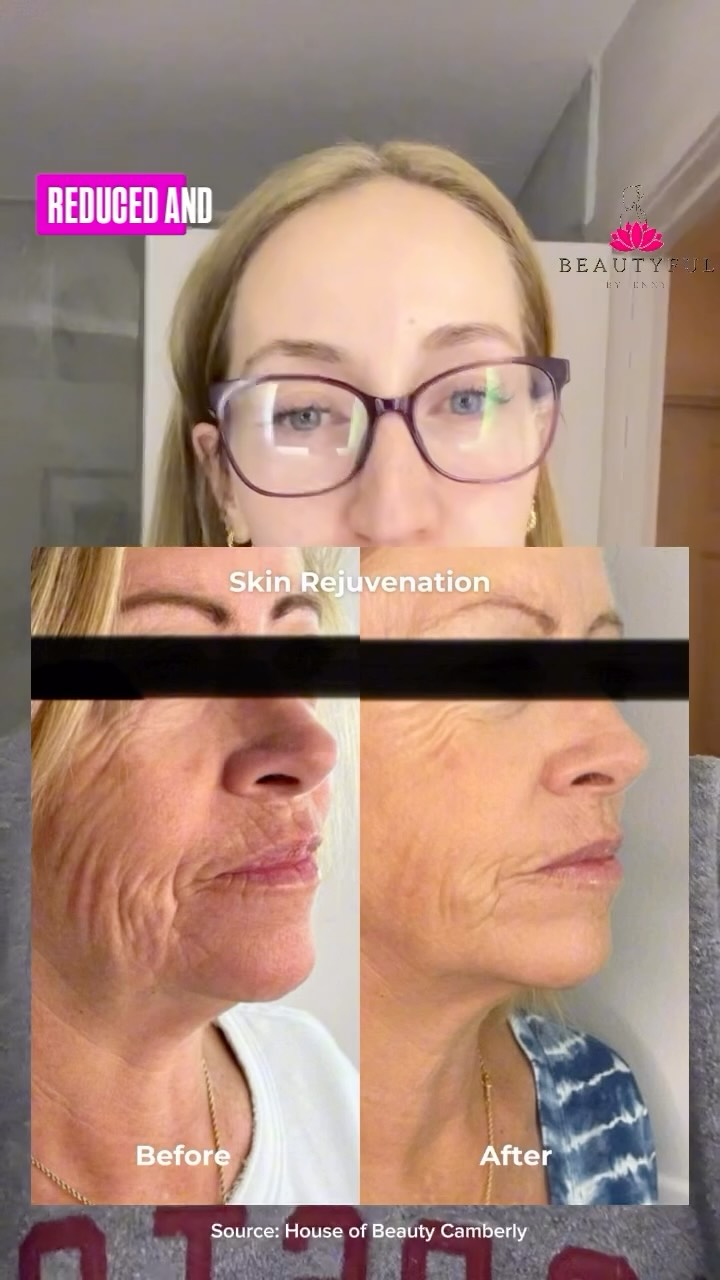 This is your Monday evening reminder that the micro needling offer expires on Friday the 31st! ๐ป
4 sessions for the price of 3, saving over โฌ100!
The benefits of micro needling are really just amazing, very minimum downtime, it can help with wrinkles and fine lines as well as acne scars. โค๏ธ
Itโs really just a miracle treatment right here with Jenny in the salon ๐
Course is available to purchase online via the link in bio and stories, or with Jenny in the salon ๐คฉ