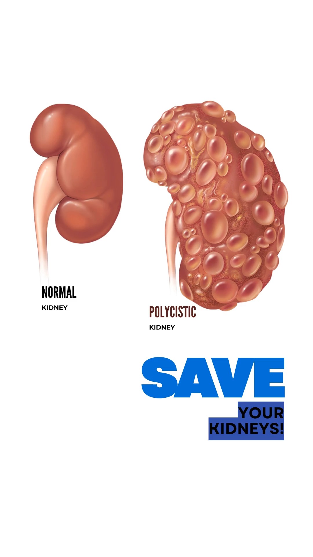Tolvaptan & PKD: What Every Patient Should Know About This Treatment 💊
If you have Autosomal Dominant Polycystic Kidney Disease (ADPKD), this information could change your disease trajectory.
Let me break down the Tolvaptan data as your nephrologist 🩺
📊 THE TEMPO 3:4 TRIAL:
1,445 adults with early ADPKD followed for 3 years
Tolvaptan vs. Placebo Results:
✅ 49% reduction in kidney volume increase
✅ Slowed kidney function decline by ~1.3 mL/min/1.73m²
REAL LIFE:
For patients with rapidly growing kidneys, Tolvaptan can delay kidney failure by SEVERAL YEARS—sometimes even a decade.
When you're facing eventual dialysis or transplant, gaining years of better kidney function is life-changing.
🔬 REPRISE TRIAL (Follow-Up):
Extended these findings to LATER-STAGE PKD patients, confirming benefits over 12 months.
Translation: Tolvaptan can help at multiple disease stages, not just early PKD.
THE REALISTIC TRUTH:
Tolvaptan does NOT cure PKD. It does NOT stop progression completely.
BUT—it CAN significantly slow disease progression and delay kidney failure.
Think of it like this: You're on a train heading toward kidney failure. Tolvaptan doesn't stop the train, but it slows it down considerably—giving you more years of better function.
WHO MIGHT BENEFIT:
- Early ADPKD with rapid progression
- Evidence of growing kidney volumes
- Risk of rapid function decline
- Some later-stage patients (per REPRISE)
IMPORTANT REALITIES:
⚠️ Side effects exist (frequent urination, increased thirst)
⚠️ Requires liver monitoring
⚠️ Not appropriate for everyone
⚠️ Needs careful nephrologist oversight
⚠️ Cost and insurance considerations
#PKD #PolycysticKidneyDisease #ADPKD #Tolvaptan #KidneyDisease #PKDTreatment #Nephrology #SeanHashmiMD #ChronicKidneyDisease #KidneyHealth #PKDAwareness #RenalDisease #MedicalEducation #DoctorExplains #PKDCommunity #KidneyResearch #ClinicalTrials #EvidenceBasedMedicine
This is NOT a simple "yes or no" decision. It's highly individualized based on YOUR specific disease