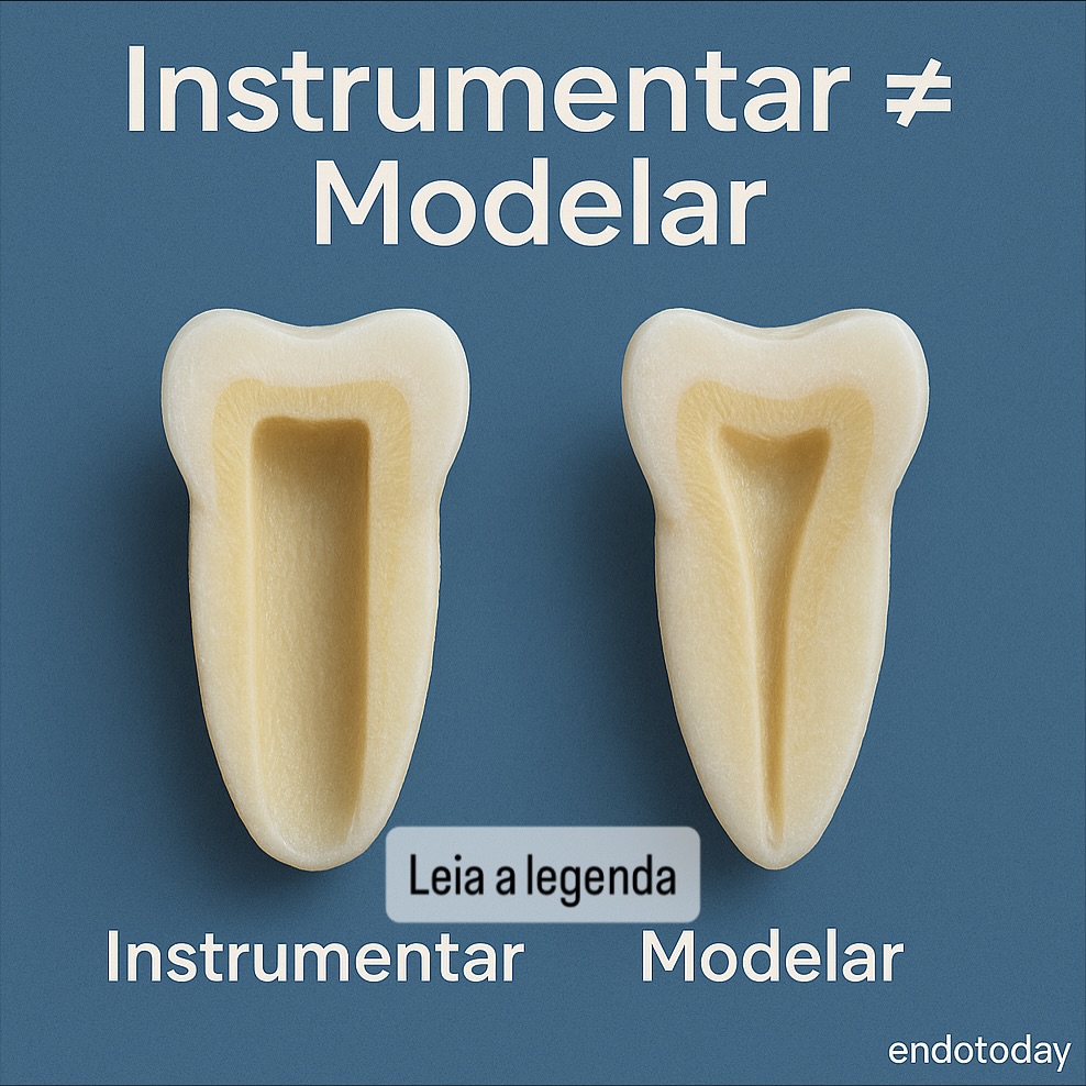 🦷 Instrumentar ≠ Modelar
Instrumentar é apenas tocar as paredes do canal.
Modelar é criar conicidade, permitir limpeza e dar forma à excelência.
💡 A diferença entre um canal “feito” e um canal bem feito está nos detalhes — e na modelagem!
👉 Salve este post pra lembrar sempre: conicidade é sinônimo de segurança!
Comenta aí ⬇️: você é #TimeModelagem ou #TimeInstrumentação?
📚 #EndoToday #Endodontia #EndodontiaModerna #Odontologia #Dentista #MicroscopiaOdontológica #EndoLove #EndodontiaComPropósito #endodontia #odontologia #endodontics #dentista #dentistry #brasil #endolovers #odonto #endodontiamicroscopica #tratamentodecanal #endo #dentistas #endodoncia #endodontic #dentist #endodontiabrasil #endodontiauberlândia #endodontiaportovelho #aorp74anos #dicasendodonticas