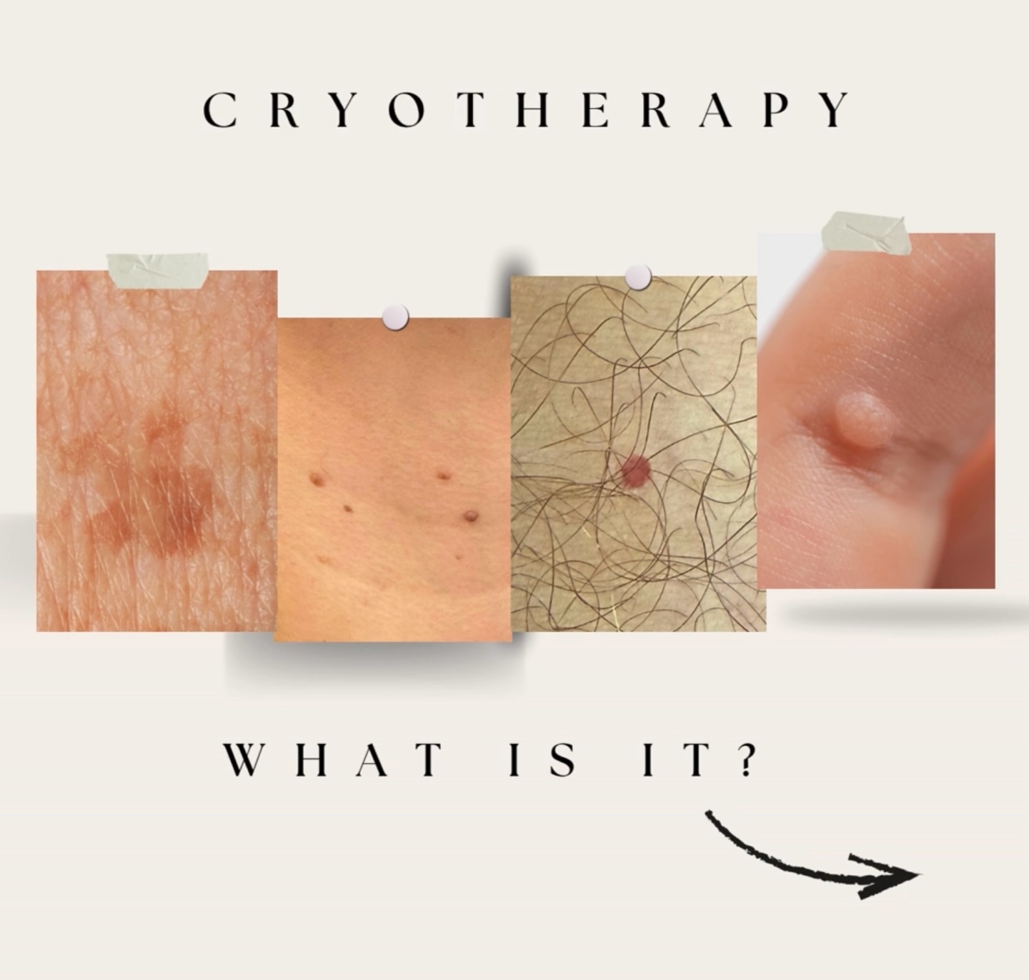 Bye bye blemishes 👋✨
Stubborn skin tags, warts, milia or pigmentation spots?
🧊Cryotherapy removes them in seconds with minimal discomfort & no downtime! 👏🏻
Comment “INFO” to register your interest 🙌🏻
#Cryotherapy #BlemishRemoval #SkinTagRemoval #MiliaRemoval #WartRemoval #PigmentationRemoval #SkinClinic #ClearSkinJourney #SkinConfidence #GlowingSkin #NonSurgical #SkinSolutions