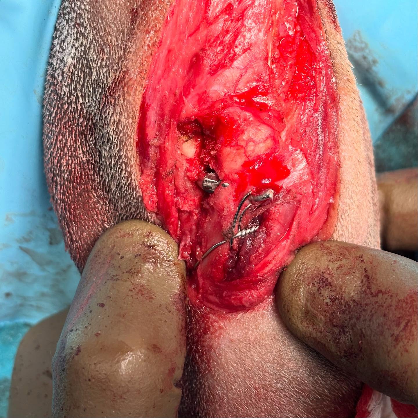 20° internal tibial torsion in a 7-year-old female spayed English Bulldog with grade 3 medial patellar luxation, treated with partial osteotomy and 4 mm spacer pin, and one-pin and tension band fixation.
———
To work out how far to move the mark on the bone, we treated the tibia’s cross-section like a circle: it measures 24 mm front-to-back, so the radius is 12 mm. A 20° untwist is 20/360 of a full circle, so the distance to slide the surface mark along the edge is that same fraction of the circle’s circumference (2πR).
Calculation:
s = (20/360) × 2π × 12 mm ≈ 4.19 mm (The straight-line span between the two points— the chord—would be 24 × sin(10°) ≈ 4.17 mm, essentially the same.)