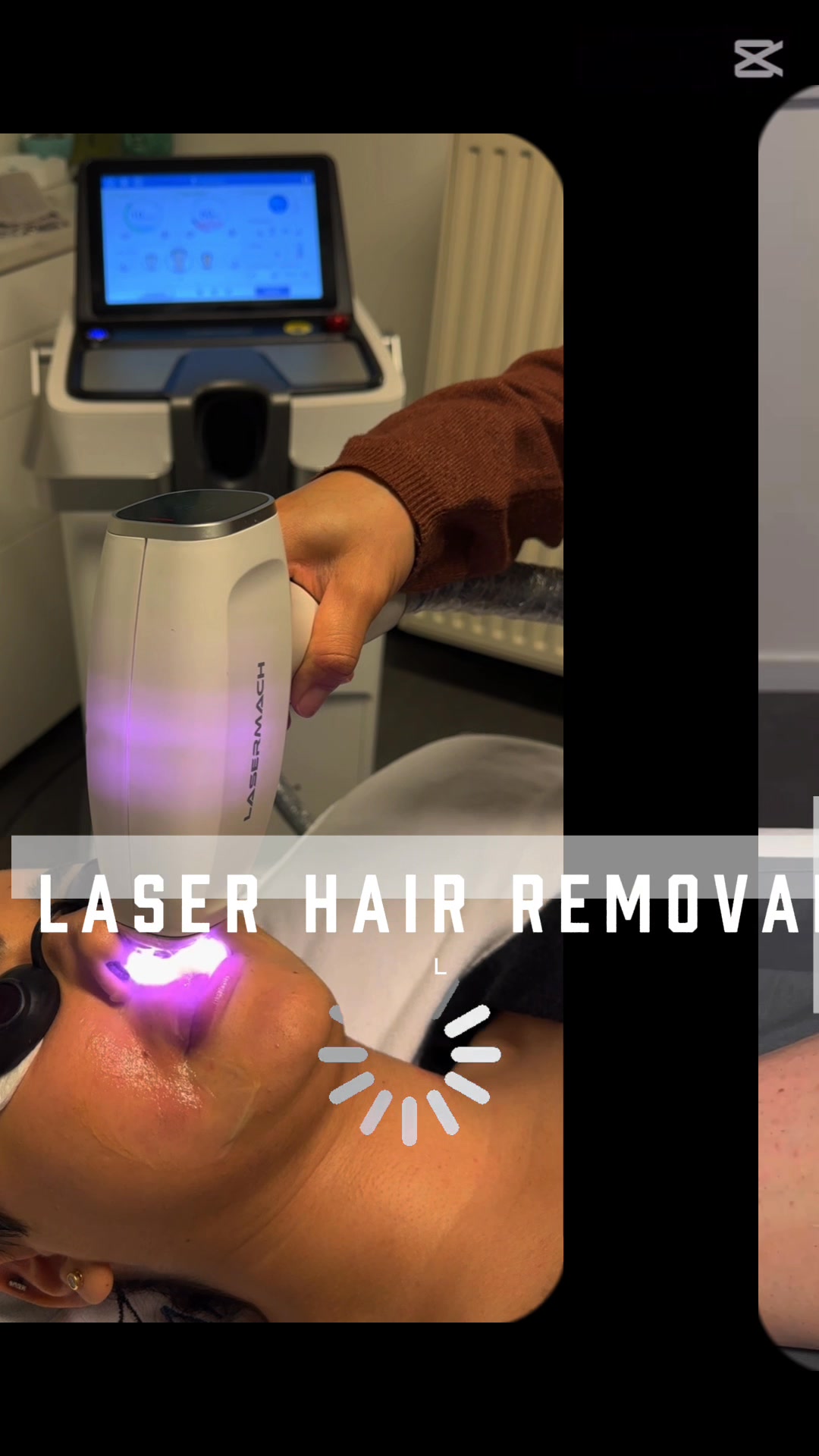 Laserontharing met gegarandeerd resultaat! Maxelbeauty BVBAVolgers #pelt #genk #hasselt #neerpelt #lommel #overpelt #hamon #eksel #bocholt #bree #houthalen #peer #mol #leopoldsburg #kinrooi #hechteleksel #stadlommel #hamontachel #oudsbergen #toerismebalen
