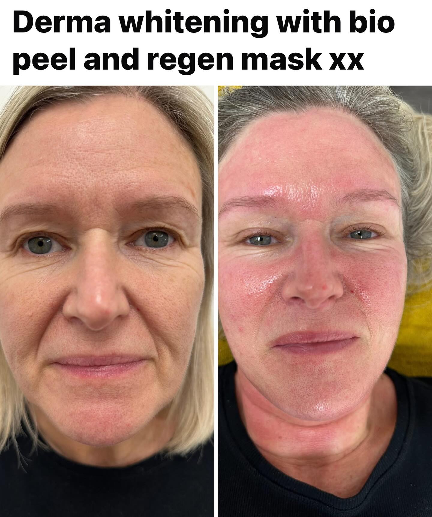 @tjpa.co.uk #microneedlingtherapy #skintagremoval #skincareroutine