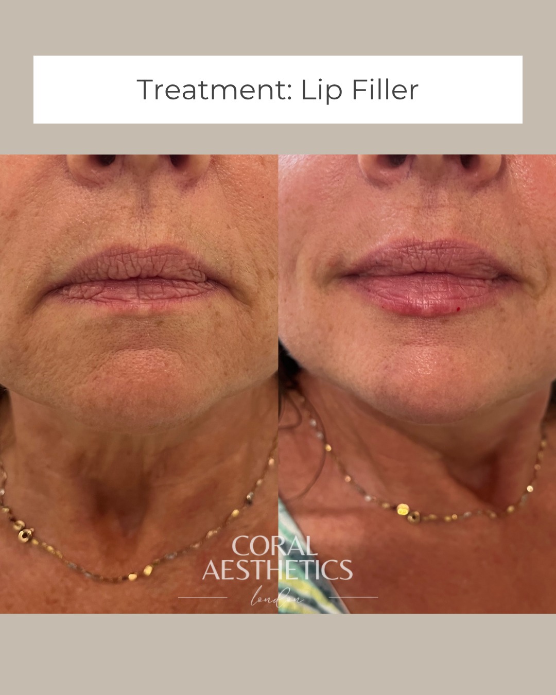 Sometimes it’s not about more, it’s about balance.
As we age, we naturally lose volume around the mouth — lips thin, corners drop slightly, and the lower face can start to look less defined.
A little well-placed filler can restore what’s been lost, subtly lift the mouth and bring back that soft, youthful structure that frames the face so beautifully.
The goal isn’t to change your features. It’s to bring them back into harmony.
Natural. Refreshed. You. 💋
You can book in with Nurse Coral in London, Essex or Kent for treatment today using the link in the Bio.
#naturallipfiller #lipfillerexpert #lipspecialist #naturallookinglipfiller #hyaluronicacid #MaiLilips #aestheticslondon #aestheticclinickent