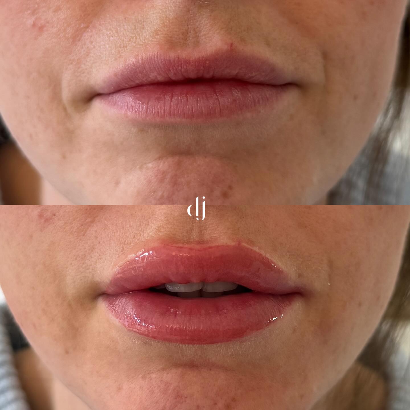 Lip Blush - Before & After - Front & Side View
Price £𝟐𝟕𝟓
Top up £𝟕𝟓 (top ups are 6 weeks after 1st sitting)
𝐏𝐫𝐞𝐬𝐬 𝐭𝐡𝐞 𝐁𝐨𝐨𝐤 𝐛𝐮𝐭𝐭𝐨𝐧 ⬆️
#lip #lipblushtattoo #lipblushtraining #pmu #pmulips💋 #pmuartist #permenantmakeup #lipblushuk #lipblushliverpool
