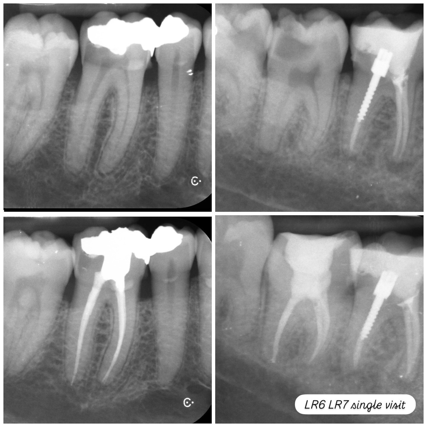Lr6 and Lr7 single visit endo. Conservative shapes, activated irrigation, WVC #nhs #treat #treatment #endowarrior #endodontia #rootcanaltreatment #rootcanaltherapy #endobelly #waves #waveonegold #saveteeth #endospecialist #treatyourself #simplicity #dentaltreatment #compositebonding #dentistry #endodontics #dentaltreatment #difficultendo