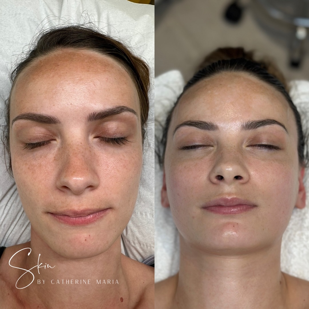 Nothing but healthy skin over here 🤍
When my client first came in for a consultation back in June 2023, her main concern was pigmentation.
Here’s something I always remind my clients: we can’t completely get rid of pigmentation, but we can absolutely manage and minimise it. With the right treatments, good home care, and consistency, the skin can become brighter, healthier, and more even over time.
Here are some signs of healthy skin:
• A natural, balanced glow
• Smooth texture and even tone
• Hydrated, comfortable feel
• A strong, resilient skin barrier
It’s important to remember that none of this happens overnight, and that’s ok. Skin health is a long game. Every cleanse, serum, SPF application, and professional treatment adds up.
So if you’re on your own skin journey, remember:
🌿 Stay consistent
🕒 Be patient
✨ Celebrate the small wins along the way
Healthy skin is possible, it just takes time, care, and commitment.
🗓️ Book via the link in bio
📍 Aylesbury, Buckinghamshire
📞 07759567391
📩 info@skinbycatherinemaria.com
🌍 www.skinbycatherinemaria.com
#aylesbury #aylesburybusiness #aylesburyvale #aylesburymums #aylesburyfacials #aylesburybeauty #aylesburybeautysalon #aylesburytown #buckinghamshire #buckinghamshirebusiness #buckinghamshirewedding #buckinghamshiremums #buckinghamshirelife #buckinghamshirebeauty #fairfordleys #berryfieldsaylesbury #kingsbrookaylesbury #westonturville #stokemandeville #wendover #astonclinton #waddesdon #haddenham #longcrendon #chearsley #cuddington