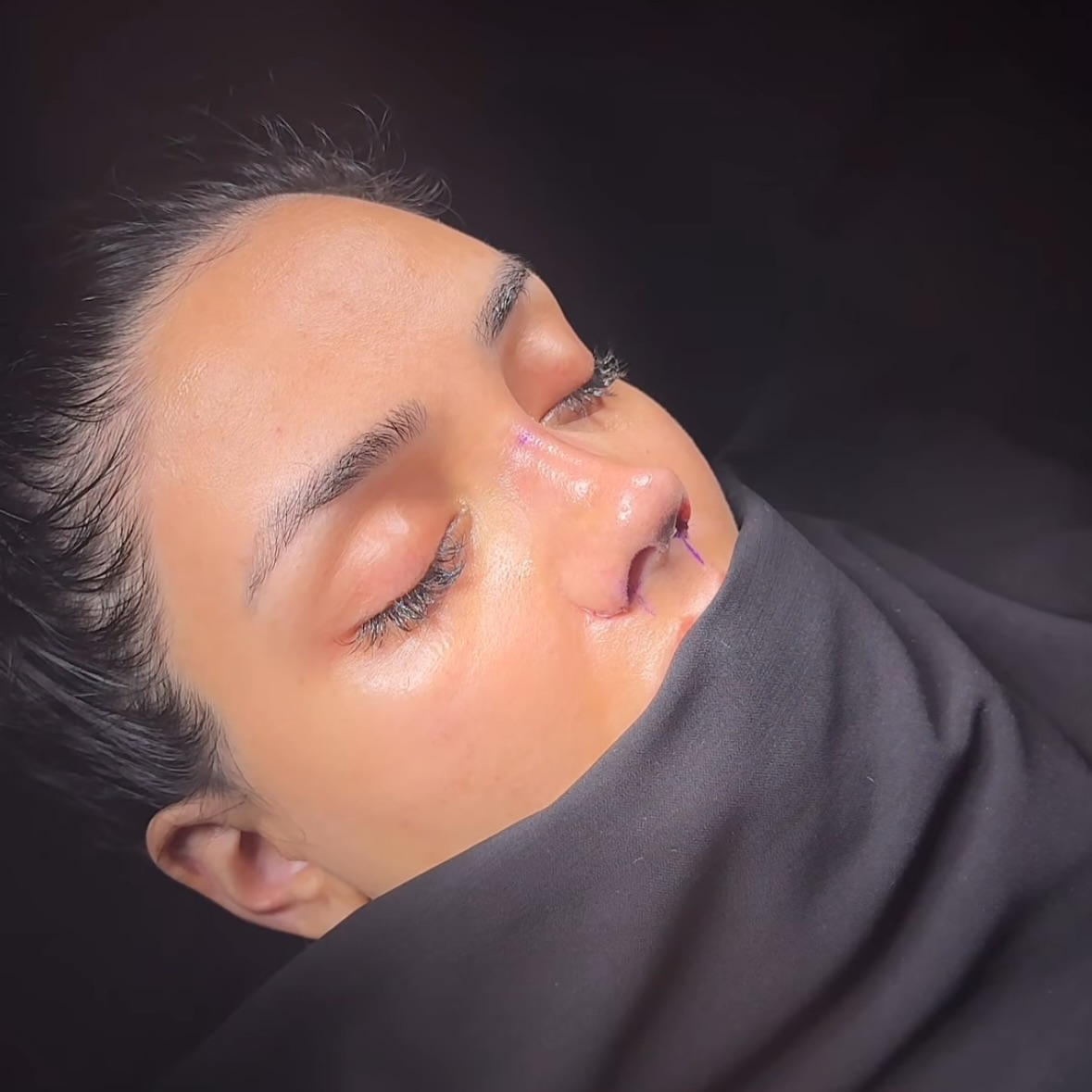 Vastagabb bőrtípusból is lehetséges szép, formás orrot varázsolni.🪄🤍
📩 Kérdésed van a folyamatról vagy a beavatkozásról? Írj nekünk privátban vagy jelentkezz konzultációra!
Írj üzenetet, és segítünk az első lépésektől a teljes átalakulásig! 💬💖
#esteworld #esteworldmagyarorszag #orrplasztika #piezo #nosejob #rhinoplasty