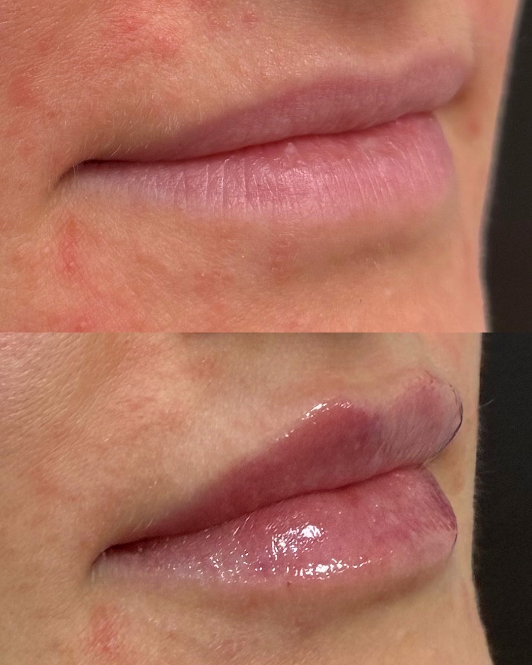 There’s a kind of magic in subtle enhancements, the kind that makes people say you look amazing, not what did you do? 🖤
Lip filler should enhance your features, not define them. It’s all about balance: soft fullness, natural shape, and a flawless finish.
#lipsbybella 💋
#lipgoals #lipfiller #wheaton #wheatonlips #naperville #napervillelips #chicago #chicagolips #filler #goals #napervillefiller #oakbrook #oalbrookfiller