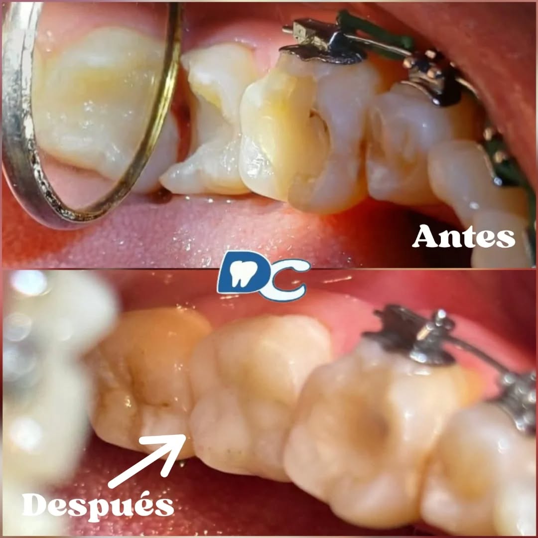 En este trabajo de la semana, ¡un gran cambio en una restauración dental! 💉🦷 Devolvimos la función y la estética a este molar partido. ¡Resultados que hablan por sí mismos!
.
.
.
.
#restauracióndental #sonríeconconfianza #calicolombia