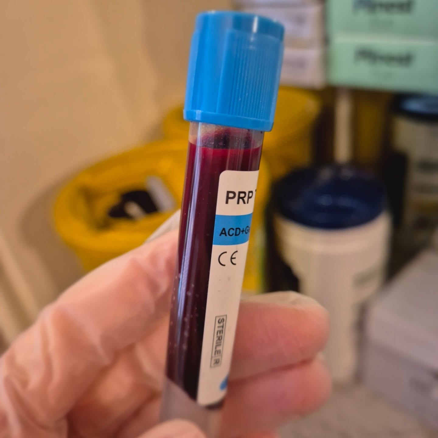 💉✨ Swipe to see your blood turn into liquid gold! ✨
This is the science behind PRP (Platelet-Rich Plasma) — one of the most powerful, natural treatments for hair restoration and skin rejuvenation.
We start by taking a small sample of your blood, just like a routine blood test. It’s then placed in a centrifuge, which spins it at high speed to separate the components. The result? That golden layer you see — plasma rich in growth factors — your body’s own healing elixir.
💛 What is plasma?
Plasma contains platelets and powerful growth factors that stimulate cell renewal, boost collagen, and awaken dormant hair follicles.
💛 Why it works:
PRP boosts blood flow to the scalp, strengthens weak follicles, and encourages new hair growth — completely naturally.
No chemicals, no artificial products — just you, rejuvenating you.
✨ Stronger, thicker hair.
✨ Healthier scalp.
✨ Real, natural results.
Ready to experience the power of your own plasma?
📅 Book your PRP consultation today and see why it’s called liquid gold.