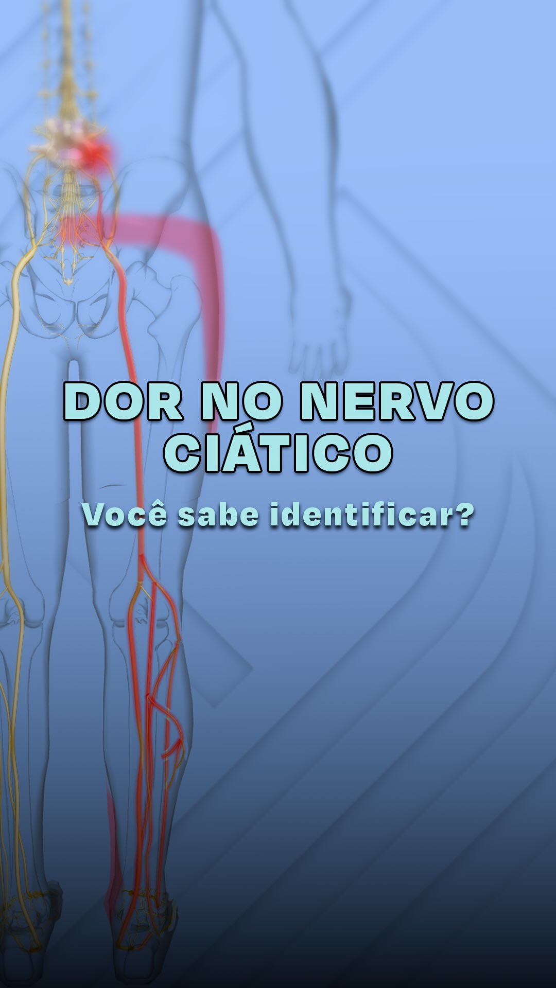 A dor do nervo ciático é uma das queixas mais comuns que atendo no consultório.
Ela costuma ser intensa, em forma de choque, queimação ou ardência, e segue o trajeto do nervo que se origina na coluna lombar, passando pelo glúteo, parte posterior da coxa, panturrilha e chegando até o calcanhar.
Em alguns casos, pode vir acompanhada de formigamento, dormência ou até fraqueza na perna, dificultando a caminhada.
É importante diferenciar da dor muscular, que geralmente é mais difusa, piora com o movimento e não apresenta sensação de choque ou queimação.
Reconhecer o tipo de dor é essencial para um diagnóstico correto e para o tratamento adequado.
👉 Para mais dicas sobre saúde da coluna e dor neuropática, siga o perfil e acompanhe os próximos vídeos.
#DorCiática
#SaudeDaColuna
#HerniaDeDisco
#DorLombar
#Neurocirurgia
#Ortopedia
#DorNoCiatico
#ColunaVertebral
#ortopedia
#coluna
#dor
#medicina
#colunavertebral
#cirurgiadacoluna
#sociedadebrasileiradecoluna