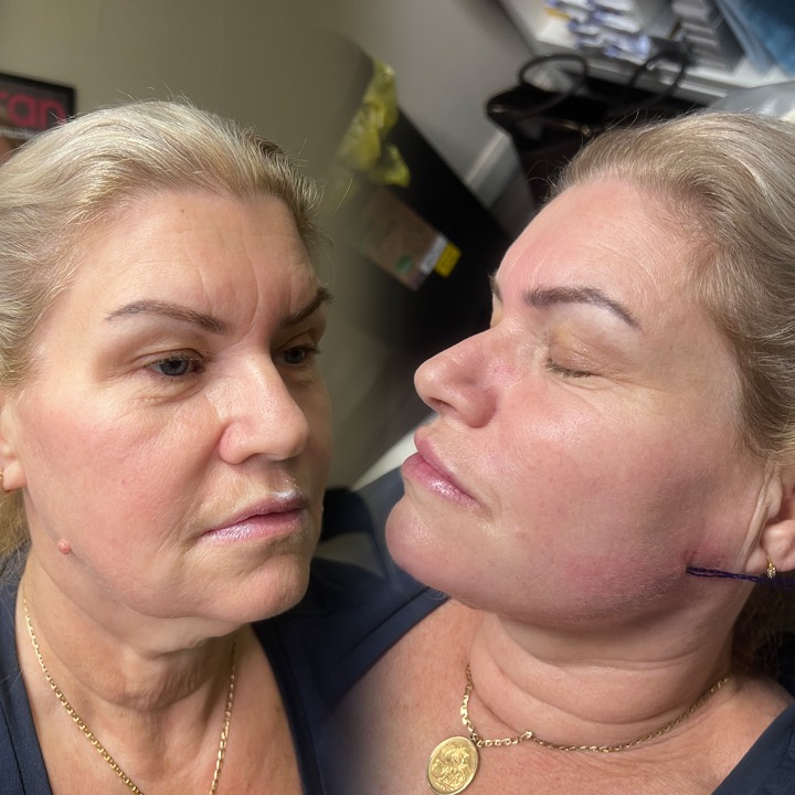 โจ Lift โข Define โข Glow โจ
Cogs & Threads paired with Filler for the ultimate rejuvenation โ expertly performed by Senior Practitioner Rachel ๐
DM to book your consultation ๐
#TheBeautyLabNorthEast #CogsAndThreads #DermalFiller #FacialRejuvenation #PDOThreads #Aesthetics #SkinLift #NorthEastAesthetics #beautyclinic