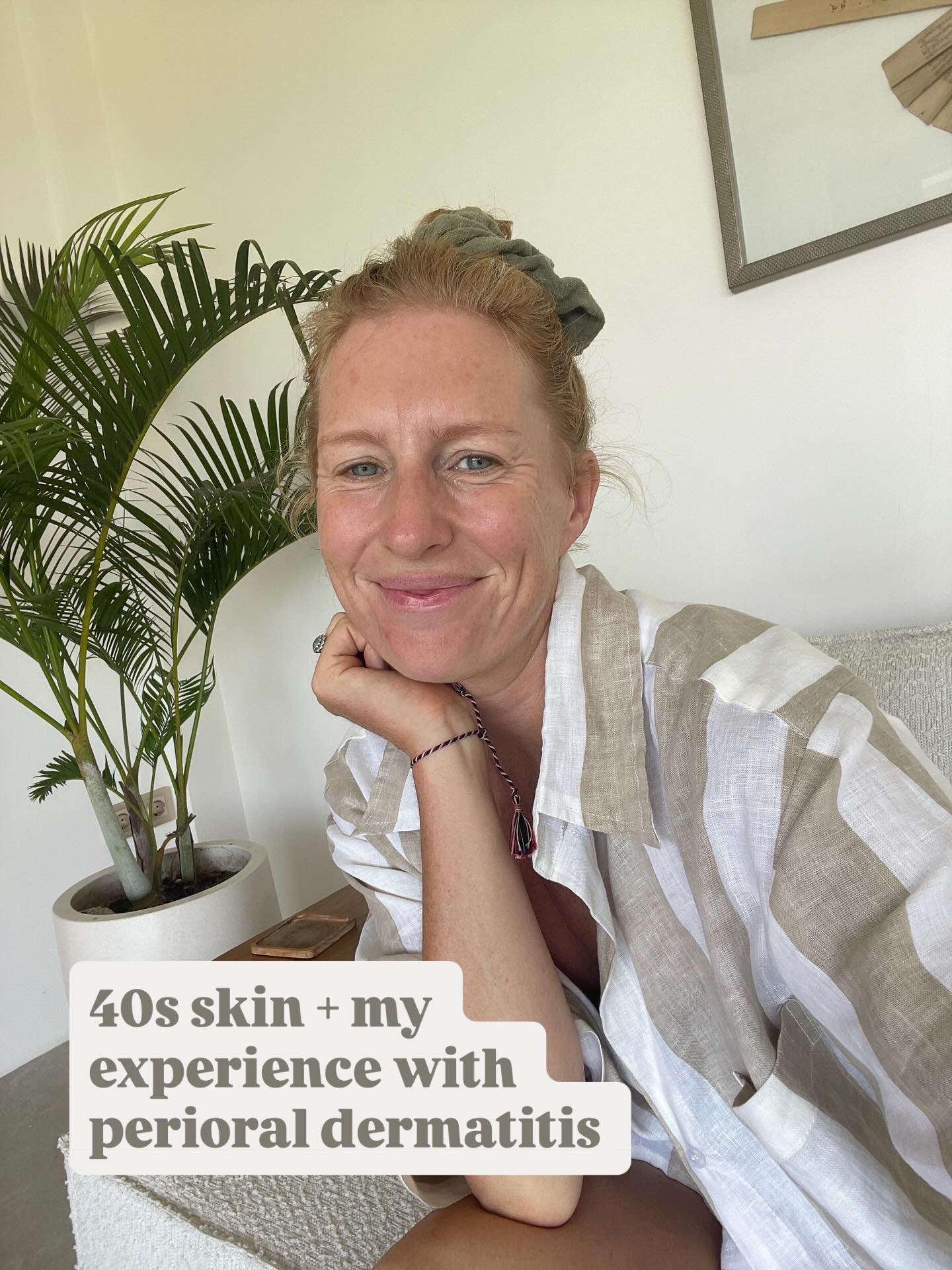 😊 Skin chat + Perioral Dermatitis
I’ve been meaning to share this for ages. It’s been a bit of a journey that came to its first head in January 2024.
Now, some people might look at this and say, “what are you moaning about?” but I’ve found it quite stressful. I’ve had many chats on DMs over the last two years, so I wanted to put everything together in one post.
📍 Perioral dermatitis: it’s a common skin condition, but it needs treatment. Red rashes appear on the chin, around the mouth, and sometimes up towards the eyes - usually symmetrical. It feels irritated and burny at times; I found it almost unbearable at night. It’s less visible on darker skin, but the pain and discomfort are still there.
Mine steadily got worse and then suddenly became very red and spread further, so I booked a dermatologist. I was travelling in New Zealand at the time, so I didn’t have access to a GP, but I think a GP would be a great first step.
I was prescribed oral antibiotics, which worked slowly - I took them for just over a month as prescribed, and they really started to help after about three weeks. The redness and spots cleared up.
I’d prefer not to take antibiotics, but that’s what was recommended. I’d tried an antibiotic cream before, but it didn’t help much, and since I sweat so much in Bali, I’m not sure it stayed on effectively.
It returned around eight months later, so I simplified my skincare again, tried a medicated cream, but ended up back on oral antibiotics (a slightly different one) for another round.
I can’t overstate how stressful this condition can be. It’s surprising, but it really is. I know anyone else dealing with it will understand. Please try to seek medical help if you can.
From a skincare perspective, the doctor said they’re seeing a worldwide increase in this condition, most likely linked to retinol creams. I was using one, and if overused, they can damage the skin’s natural barrier and trigger this reaction.
Cont’d in comment, PLEASE READ ⬇️⬇️⬇️