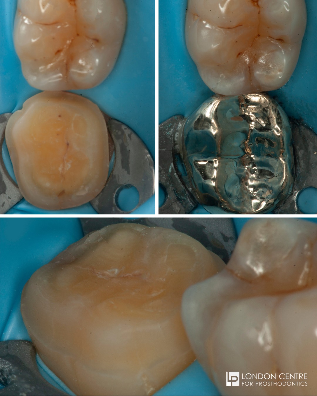 Using modern ceramic materials allow us to provide you with life-like restorations that blend seamlessly with your natural teeth. However, in certain circumstances, ceramic is not strong enough. This patient had a severe grinding habit and cracked his lower back molar tooth.
In these situations the best material with the most successful track record is still gold. We were able to restore his cracked molar with a hand crafted gold onlay restoration that was adhesively cemented into place. Gold is still an important material to consider for certain cases. Choose your dentist, not your material.
Get in touch with our team to book your appointment - we look forward to seeing you soon!
The London Centre For Prosthodontics
29 Weymouth Street
London, W1G 7DB
020 7637 4518
info@londonprosthodontics.com
Monday - Friday: 7:30am - 4:30pm
#MaryleboneDentist #LondonSmiles #HealthyTeethMarylebone #DentalCareLondon #SmileMakeover #MaryleboneOralHealth #LondonDentalExperts #CosmeticDentistry #TeethWhiteningMarylebone #EmergencyDentistLondon #MaryleboneOrthodontics #LondonDentalClinic #DentalCheckup #MaryleboneDentalCare #SmileTransformation
#LondonOralCare #MaryleboneDentalHealth #FamilyDentistLondon #TeethCleaningMarylebone #CosmeticDentistLondon #MaryleboneTeeth #LondonDentalHygiene#MaryleboneOrthodontist #OralWellnessLondon #PreventiveDentistry #MaryleboneDentalServices #LondonDentalSpecialists #MaryleboneHealthySmiles #LondonDentistry #AdvancedDentalCare