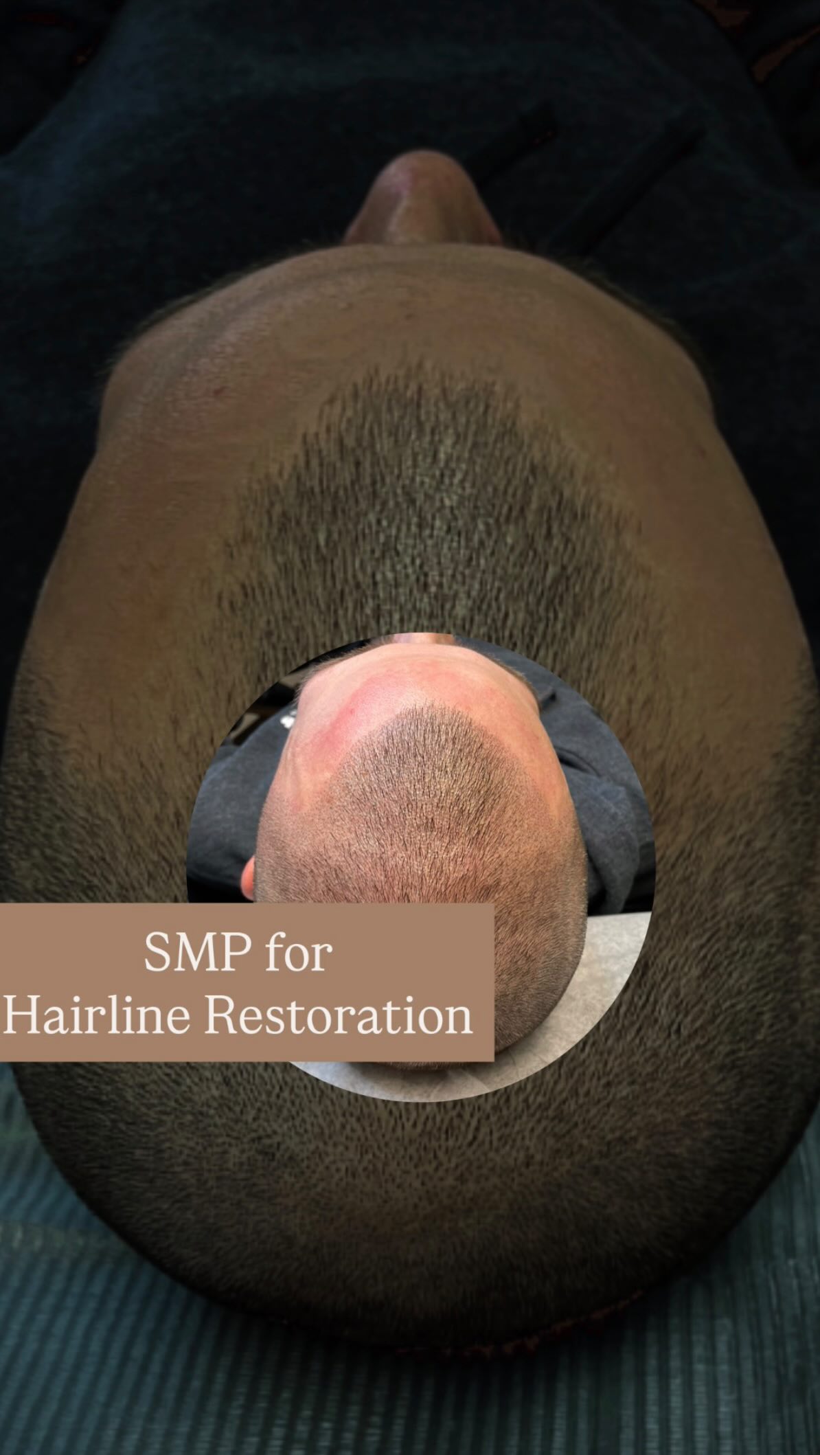 β¨SMP Hairline Restorationβ¨
Not just a new hairline..a new level of confidence.
At BLADED Inc, SMP Hairline Restoration delivers realistic density and definition that looks completely natural, even up close.
This advanced treatment recreates the look of real hair follicles for a clean, masculine hairline tailored to your features.
Serving Zionsville, Carmel, and Westfield, our SMP experts specialize in non-surgical hair restoration for men ready to reclaim a sharp, youthful look.
Tap the link in bio or comment/DM βRESTOREβ to book your complimentary consultation.
#SMPforMen #HairlineRestoration #SMP #hairrestoration #ScalpMicropigmentation #zionsville #zionsvilleindiana #zionsvilledads #zionsvillehair #zionsvillebarber #carmeldadsclub #WestfieldIndiana #BladedInc #HairConfidence #MensGroomingIndiana