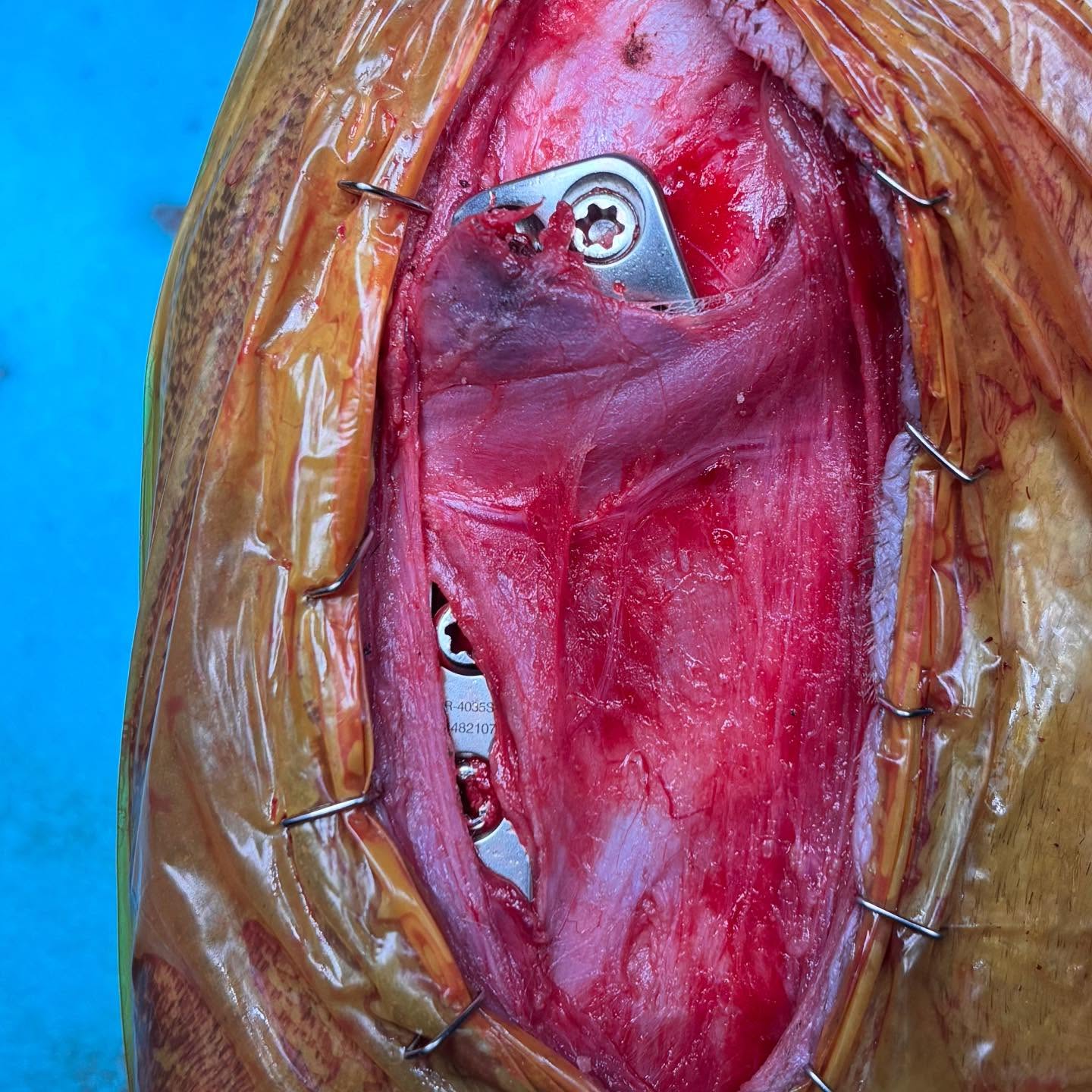 Pes-sparing TPLO in a 7-year-old MN Mixed Breed with a complete CCL tear, stabilised with a 3.5mm standard Arthrex TPLO plate. Interfragmentary compression was achieved via the eccentric DC hole, with locking screws in H1 and H3, and pointed bone reduction forceps engaging the caudal aspect of the proximal bone fragment and the cranial aspect of the tibial crest.
———
To the best of our knowledge, we have the largest current clinical experience performing a pes-anserinus–sparing TPLO, in which the conjoined tendons of the sartorius, gracilis, and semitendinosus muscles are preserved at their tibial insertion during the TPLO procedure
In human high tibial osteotomy, a biomechanically comparable procedure to the TPLO, preserving the pes anserinus attachment has been associated with faster bone healing and improved early functional recovery.
While many surgeons routinely cut or transect the pes anserinus tendon group during TPLO to improve exposure, our approach preserves these insertions intact—providing full surgical access without compromising visualization or clinical outcome, and potentially translating the same biologic and functional advantages reported in human high tibial osteotomy.