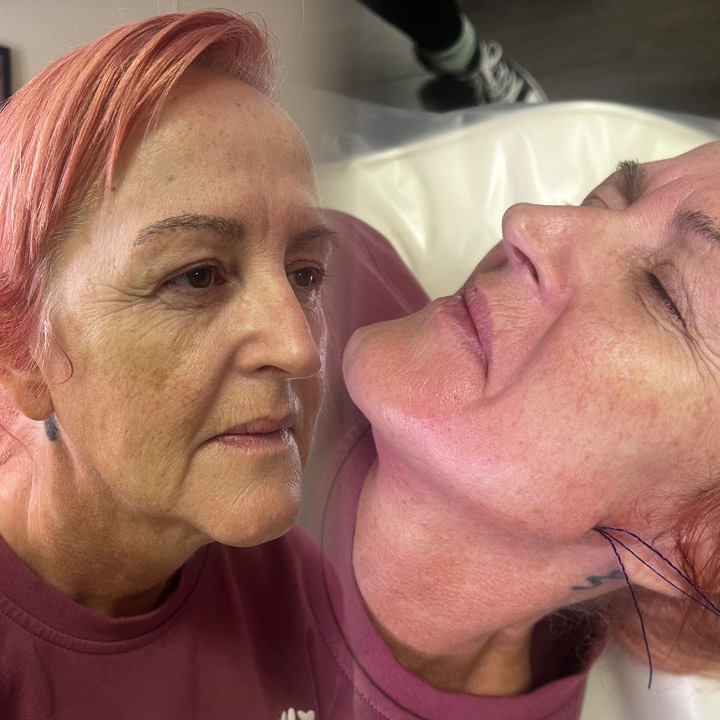 ✨ The Mini Facelift Package – Only £249! ✨
Ready to lift, tighten & refresh your look without surgery? 👀
Our Mini Facelift Package is one of our most popular treatments here at The Beauty Lab North East 💕
💎 What’s included:
➡️ 6 PDO Cog Threads for lower face lifting – perfect for reducing jowls and redefining your jawline 💫
➡️ PDO Threads for neck tightening – say goodbye to loose or sagging skin!
This gorgeous client also chose to enhance her results with 2mls of Dermal Filler (£159):
💉 1ml in the marionette lines (corners of the mouth to chin)
💉 1ml in the nasolabial folds (smile lines from nose to mouth)
These areas restore lost volume and smooth out deeper lines – creating a beautifully fresh, uplifted & youthful look! ✨
📍 Available at both our Felling and South Shields branches
👩🔬 Treatment available exclusively with Senior Aesthetic Practitioner Rachel
📅 Appointments fill fast – book yours now
#MiniFacelift #PDOThreads #LowerFaceLift #JawlineLift #NeckTightening #NonSurgicalFacelift #DermalFiller #NasolabialFolds #MarionetteLines #AntiAging #YouthfulSkin #SkinTightening #AestheticsClinic #TheBeautyLabNorthEast #FellingClinic #SouthShieldsClinic #AestheticTreatments #BeautyGoals #freshface